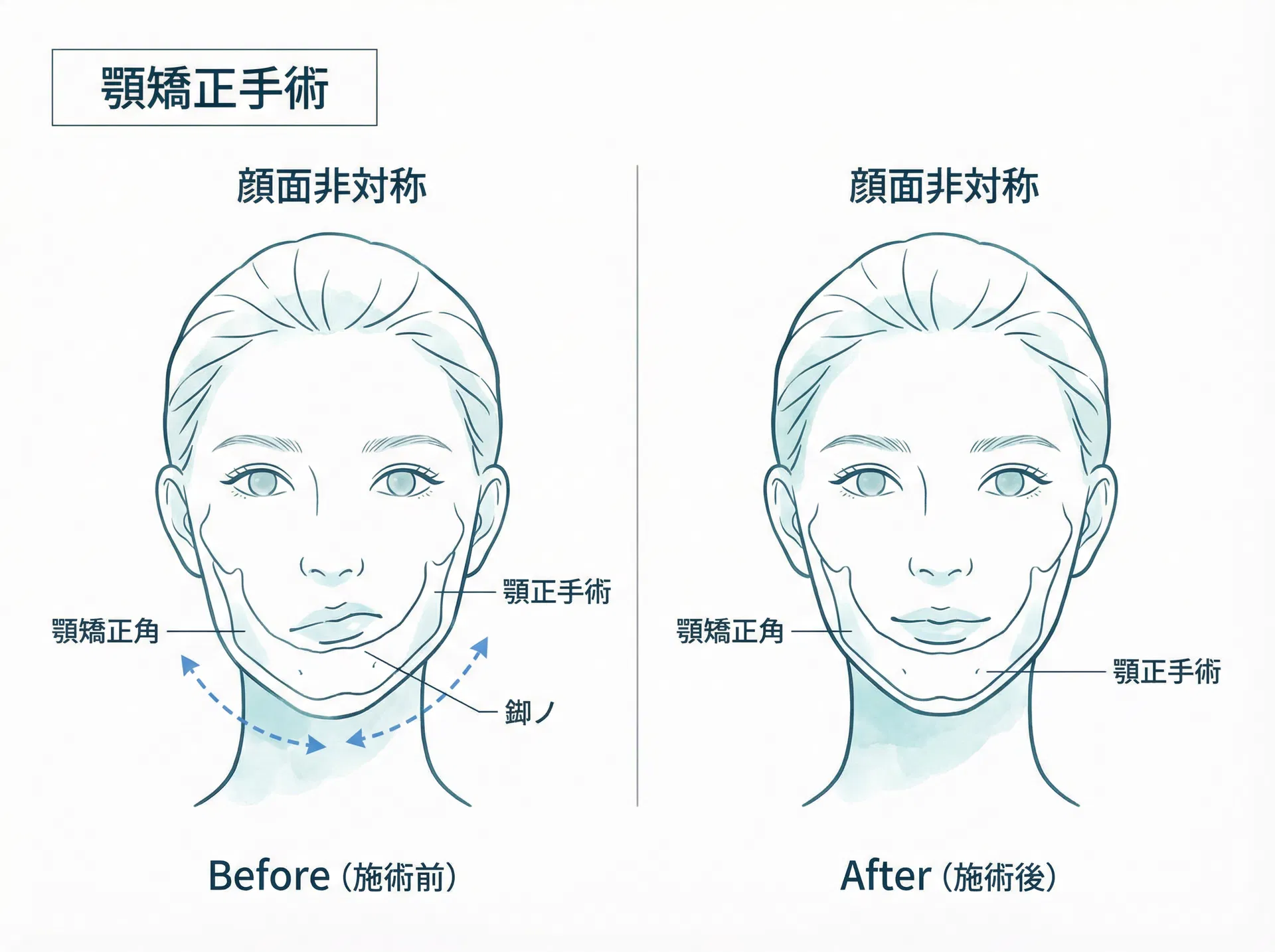 顔面非対称の改善イメージ