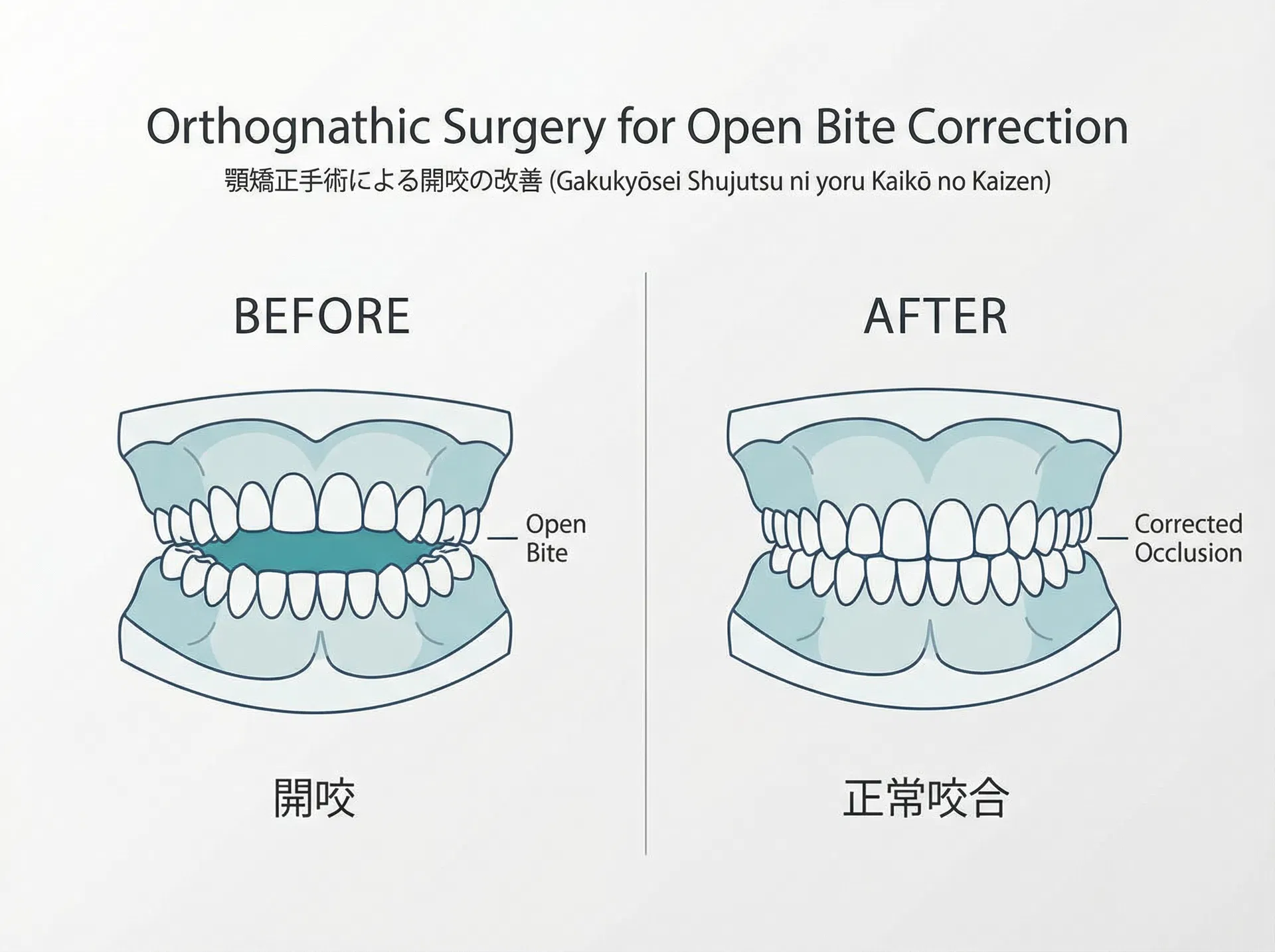 開咬の改善イメージ