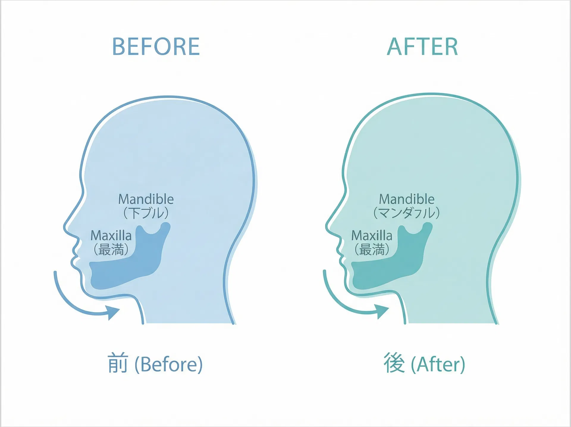 下顎前突（受け口）の改善イメージ