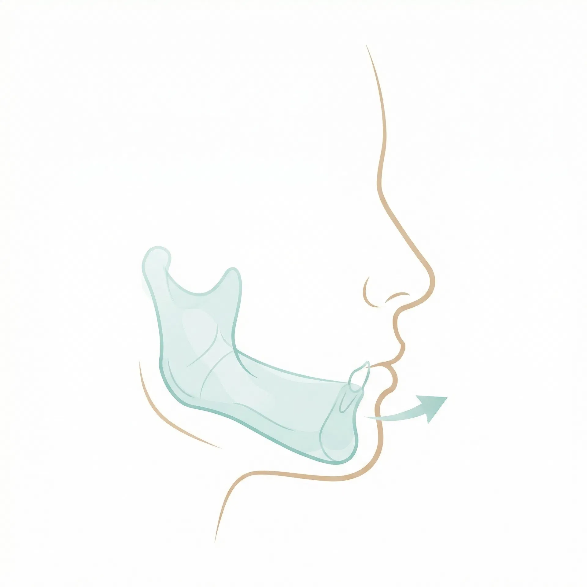 受け口（下顎前突）