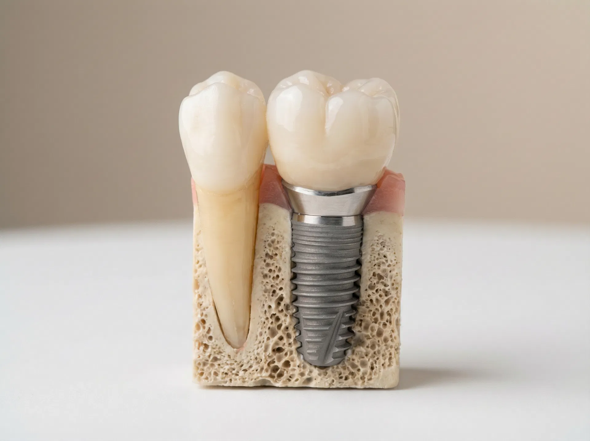 Single tooth dental implant model showing titanium screw, abutment, and porcelain crown in jawbone — dental implants Vancouver BC at Oakridge Park Dental