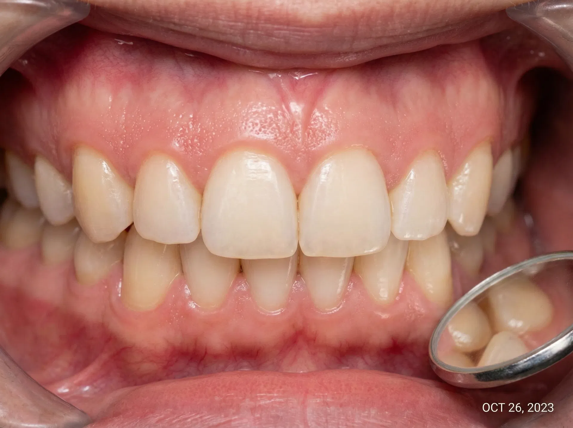 Healthy gums after laser periodontal treatment at Oakridge Park Dental Vancouver BC — fast healing with laser therapy