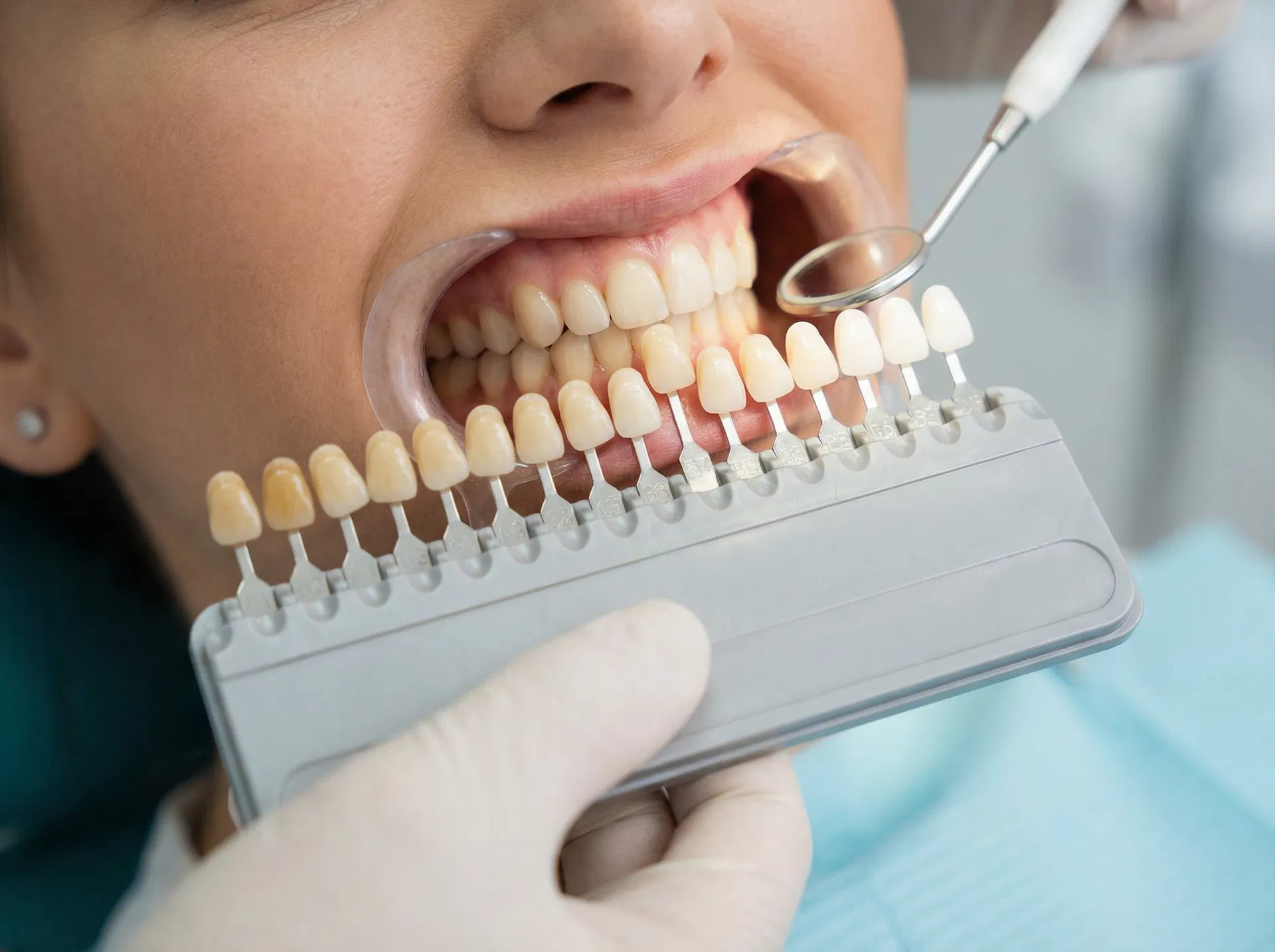 Dental shade guide comparison showing teeth whitening results — before and after shade matching at Oakridge Park Dental Vancouver BC