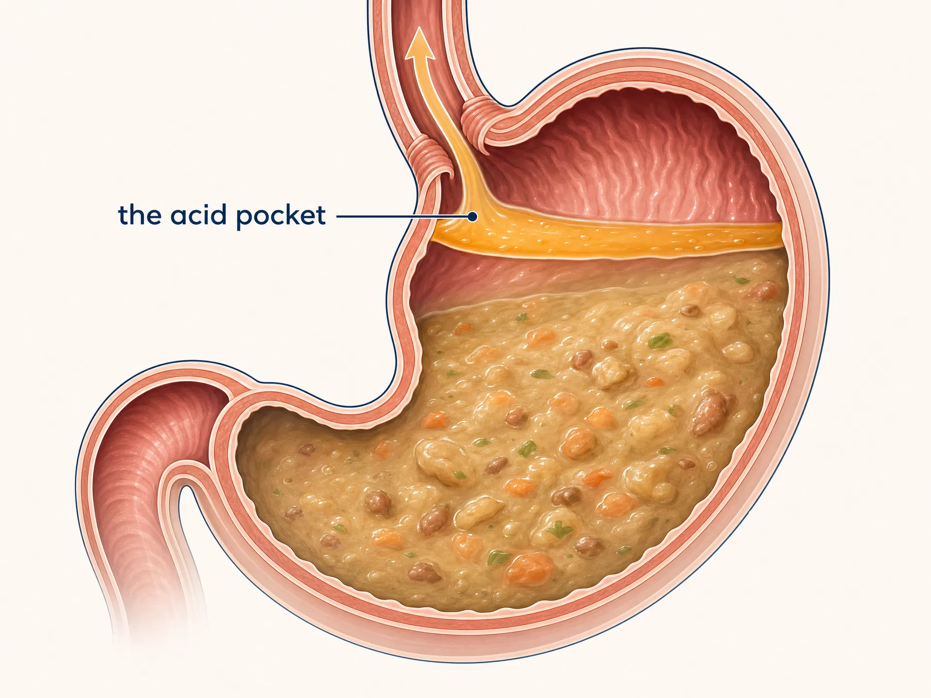 Medical illustration of the acid pocket