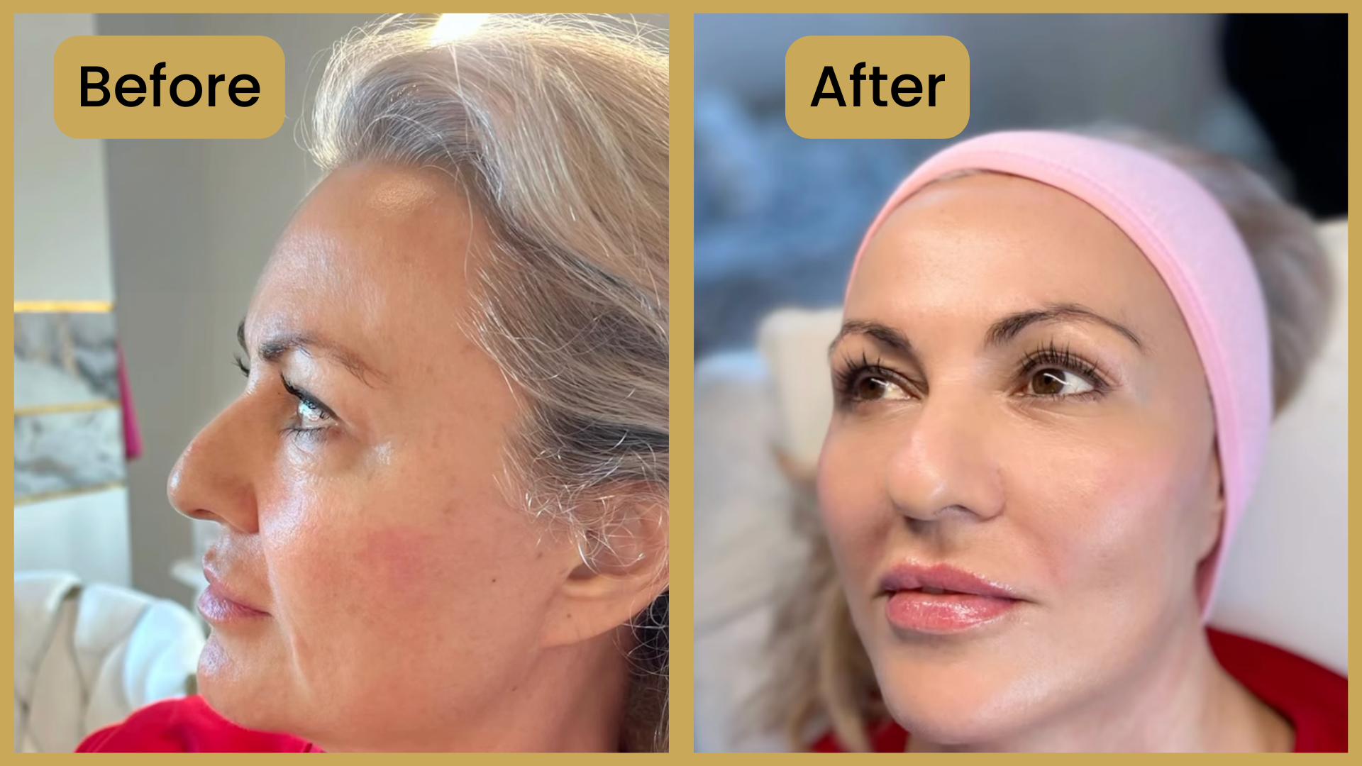 Express Rejuvenation: Natural Face Lift Without Surgery
