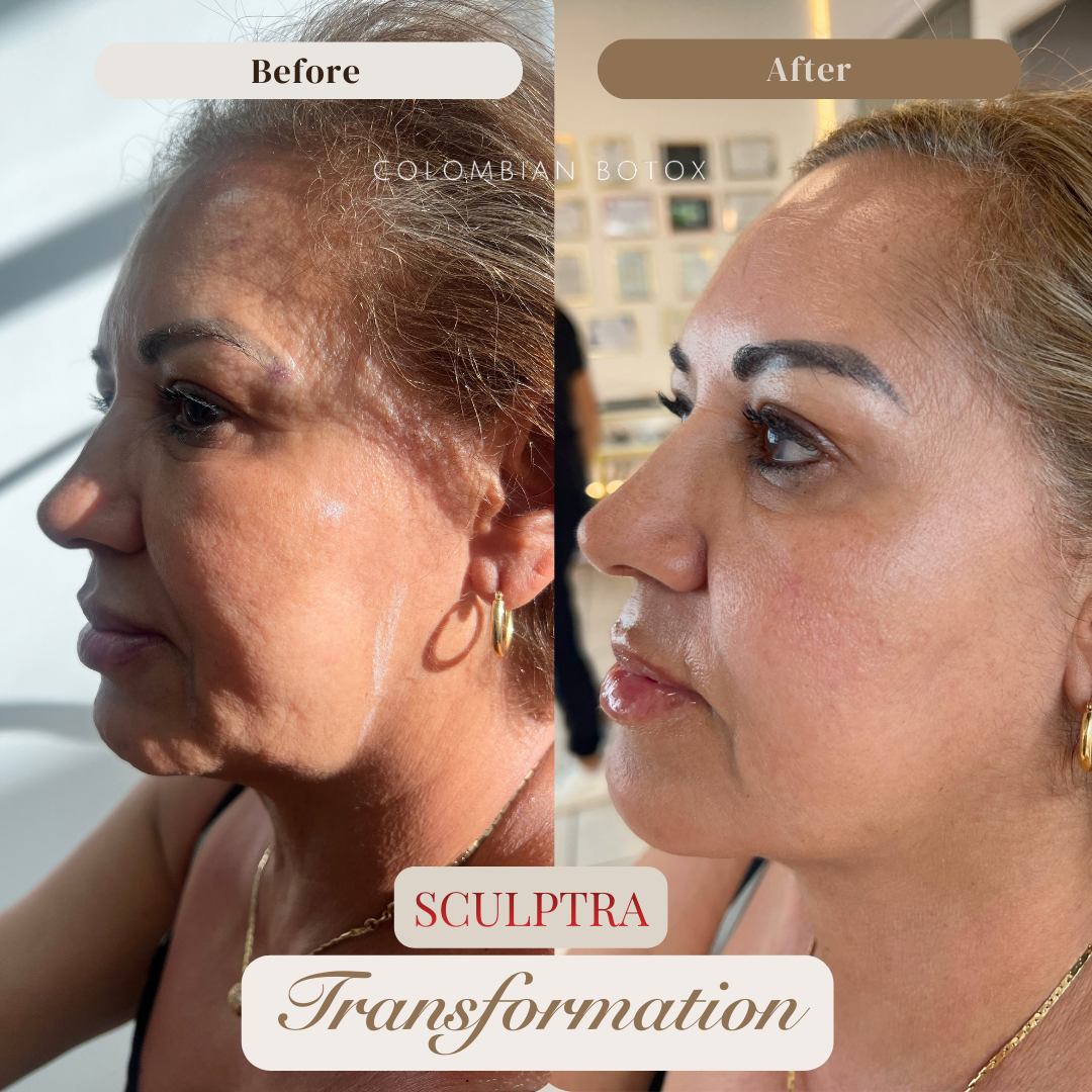 Sculptra Before and After: A 3-Year Natural Rejuvenation Journey