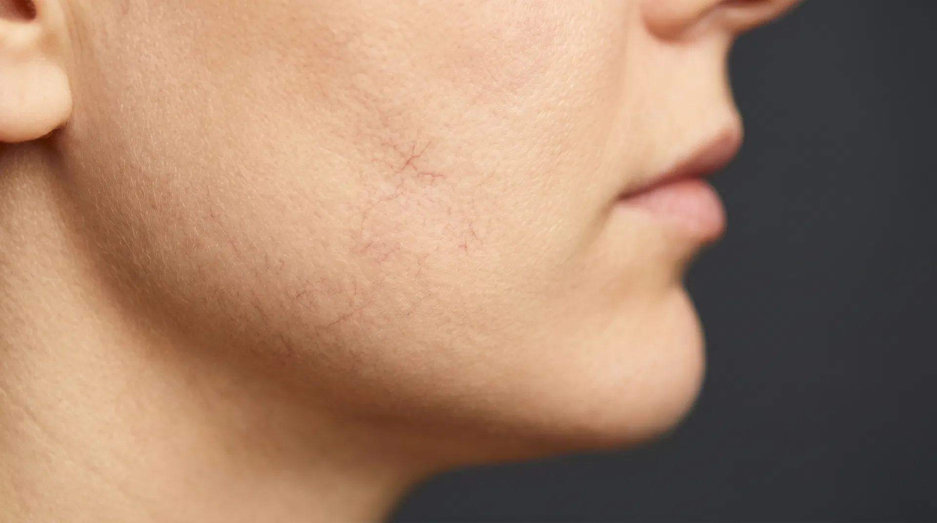 Rosacea vs. Facial Spider Veins: Understanding the Difference and How Each Is Treated