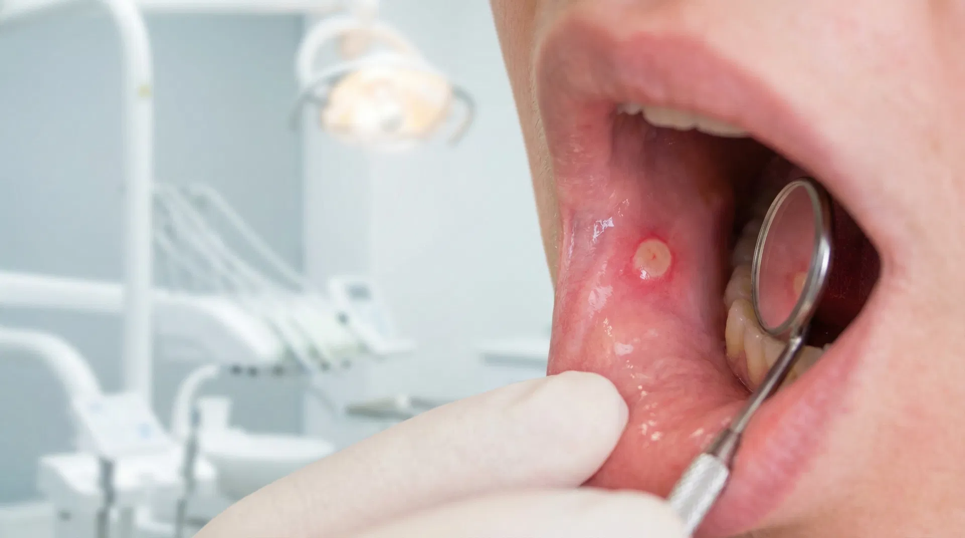 Blister i munden: Din guide til årsager, symptomer og behandling – illustration