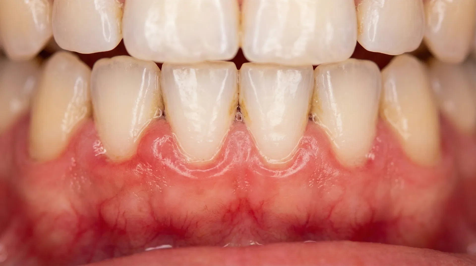 Hævet tandkød: Årsager, Symptomer, Behandling og Forebyggelse