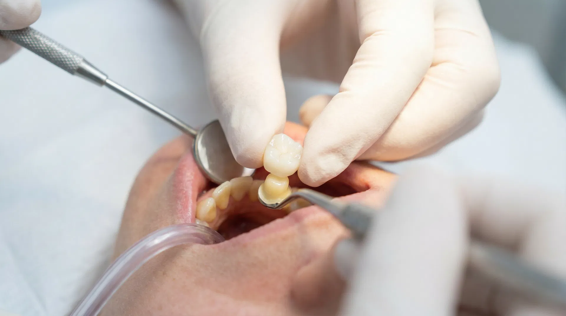 Tandkrone: Alt du skal vide om behandling, typer og pris – illustration