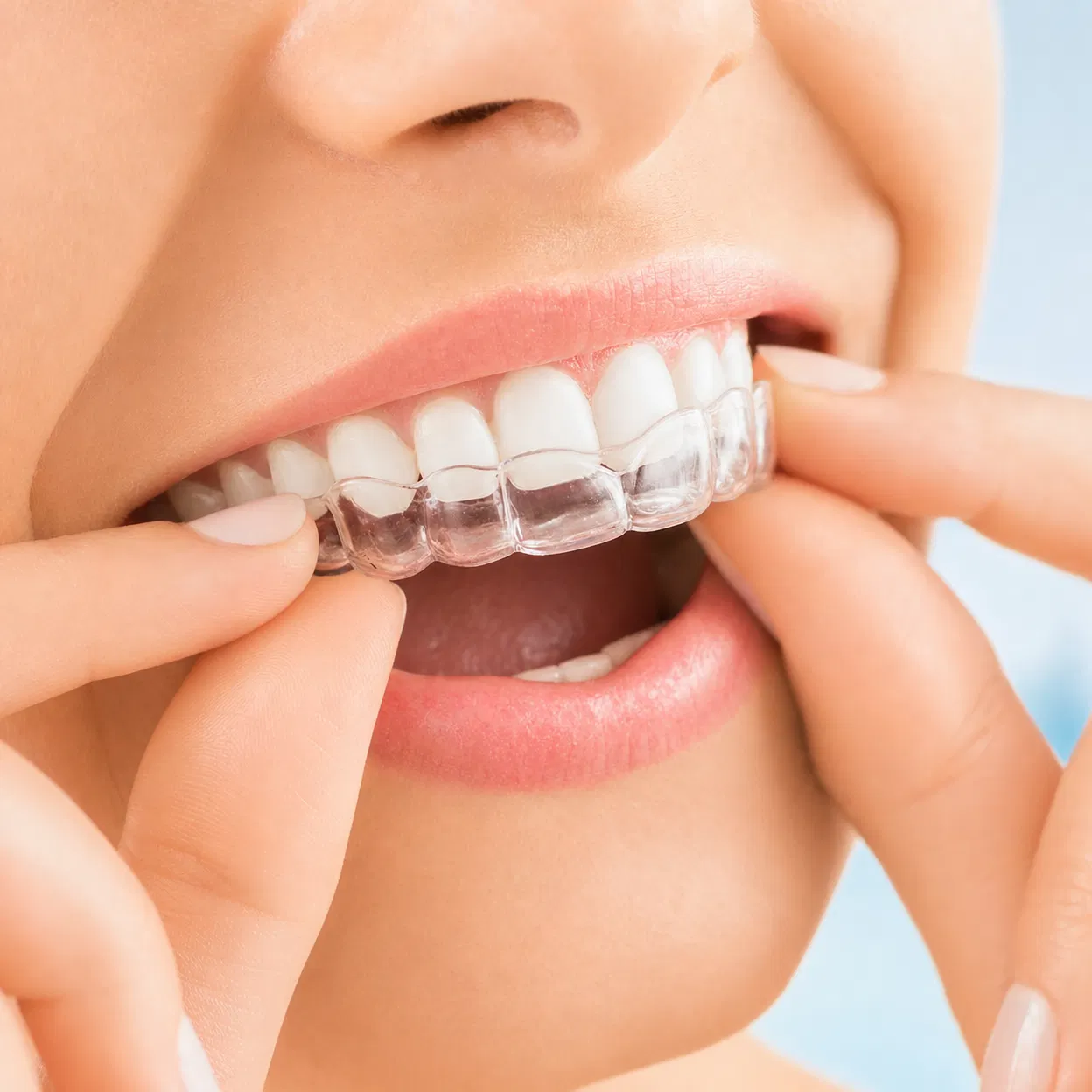 Braces & Aligners