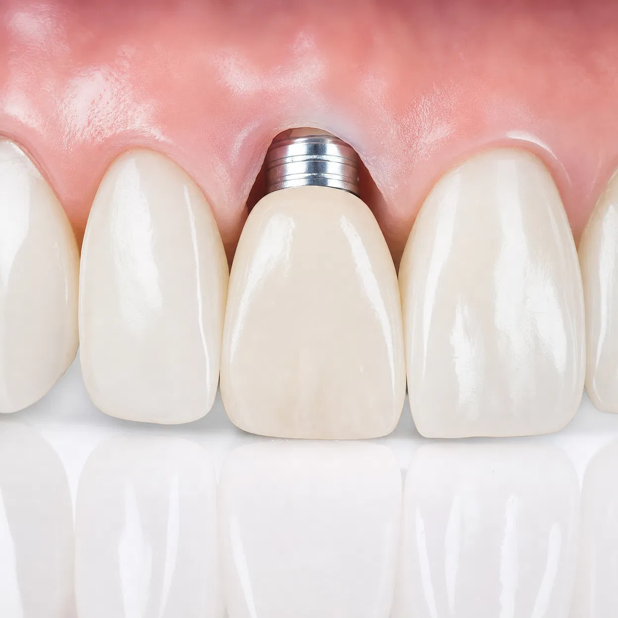 Dental Implants