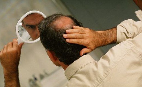 英国留学：当心脱发问题？这几些英国生发系列让您重拾信心！