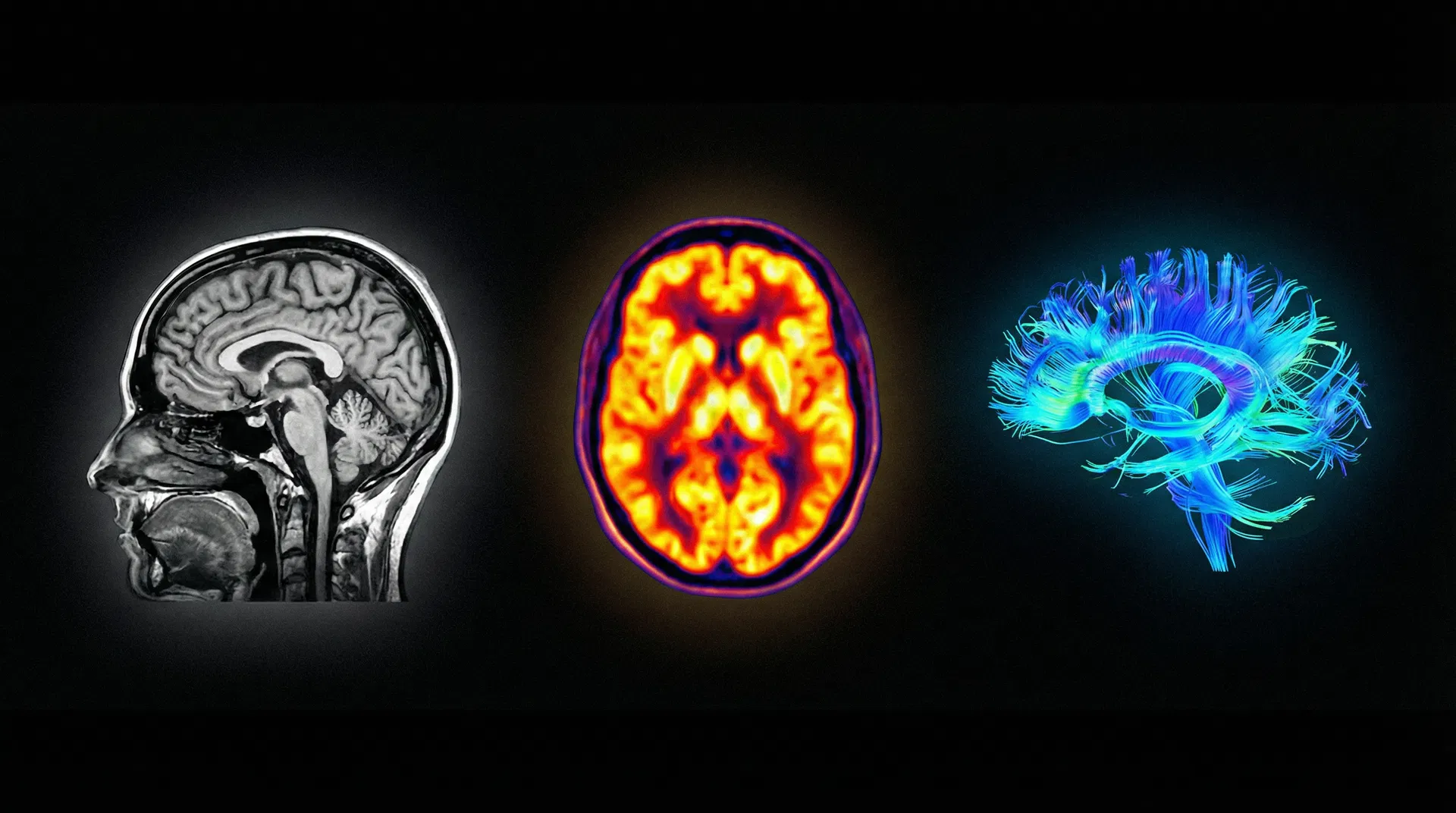 MRI, PET scan, and DTI tractography of the female brain — neuroimaging research by Louisa Nicola
