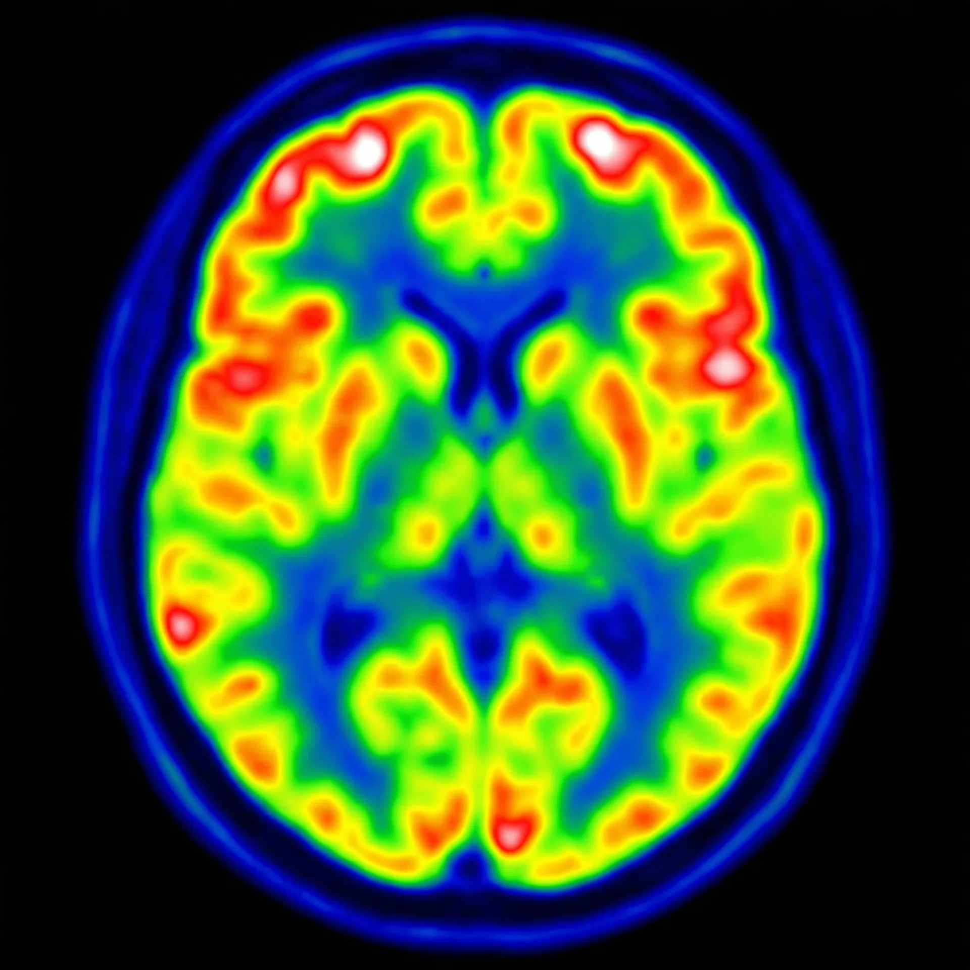 PET scan showing metabolic activity in the female brain with color-coded regions