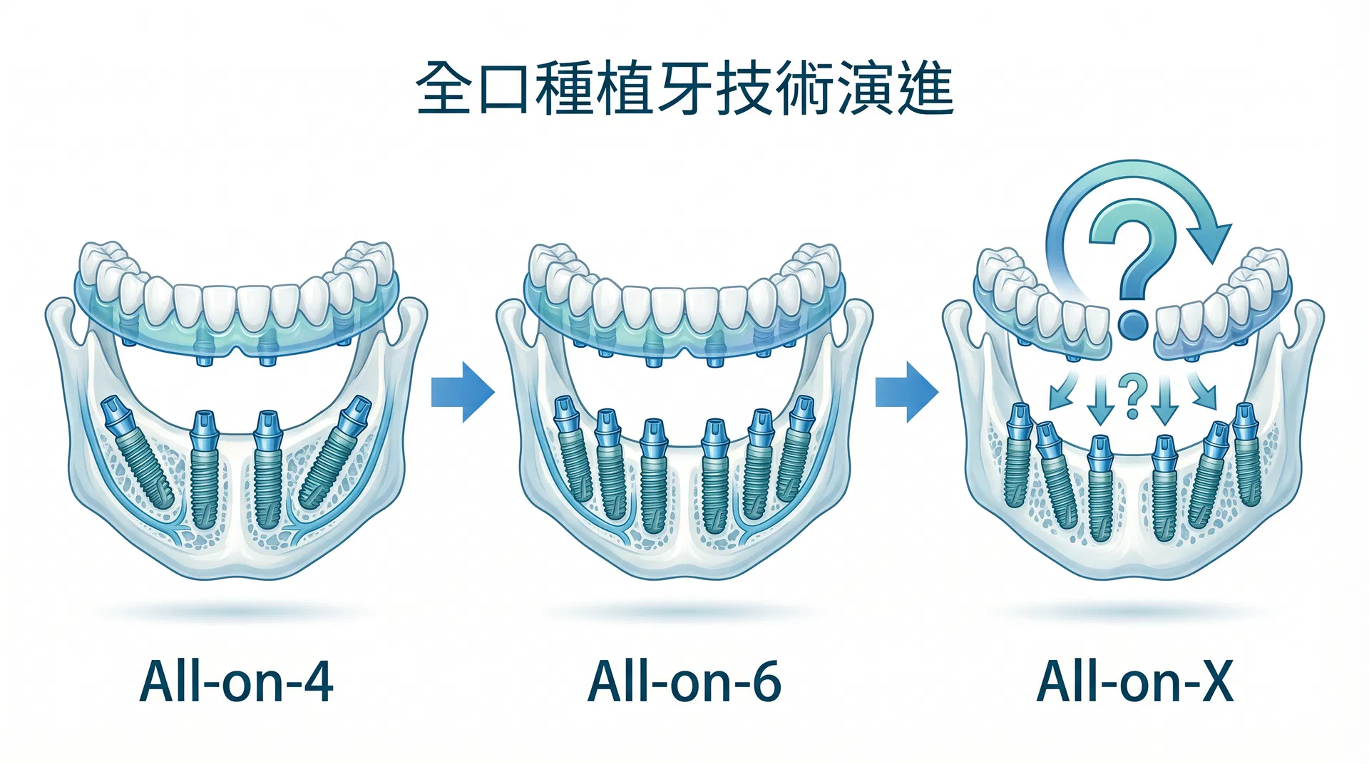 All-on-4、All-on-6、All-on-X 全口植牙技術演進示意圖