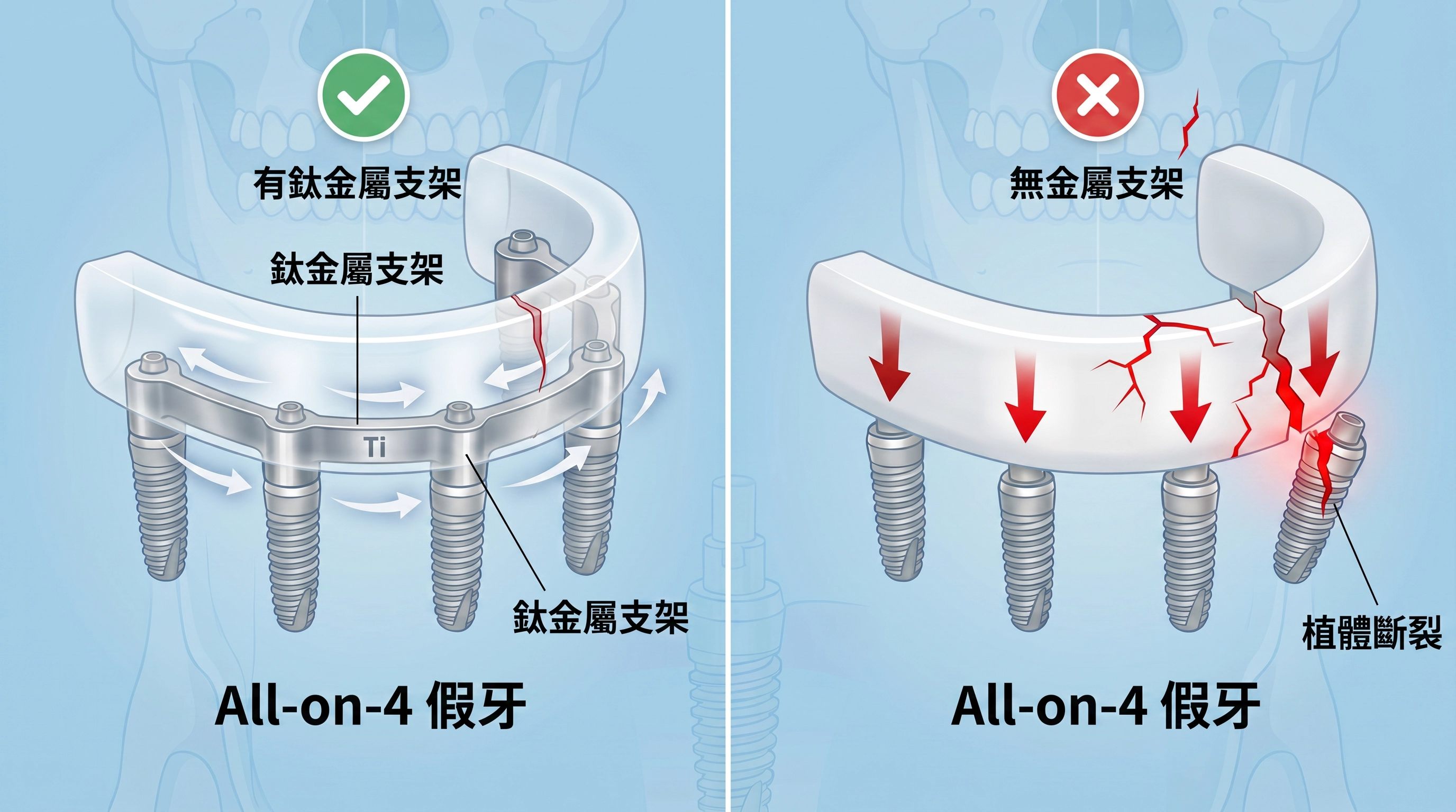 有鈦金屬支架 vs 無金屬支架的 All-on-4 假牙對比
