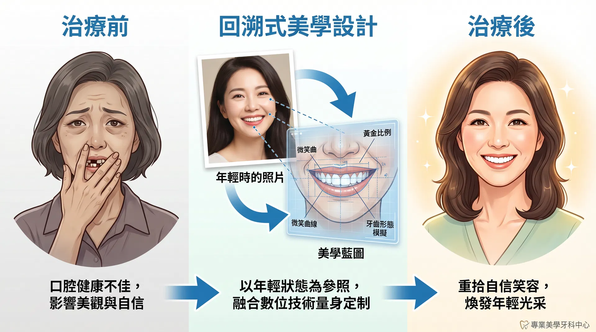 All-on-4 美學重建歷程：從缺牙到回溯式設計到年輕十歲