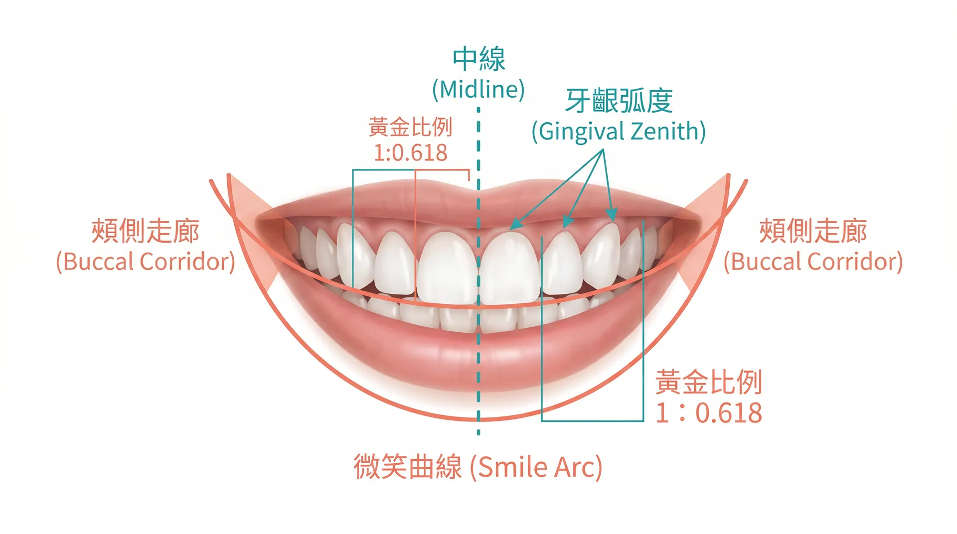 All-on-4 微笑曲線分析流程：中線、牙齒比例、牙齦弧度、頰側走廊