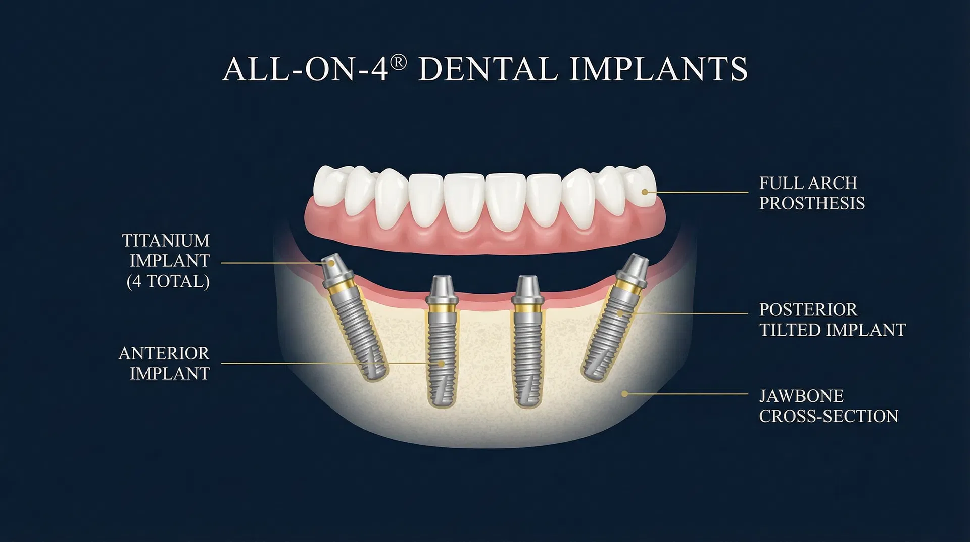All-on-4 植體示意圖