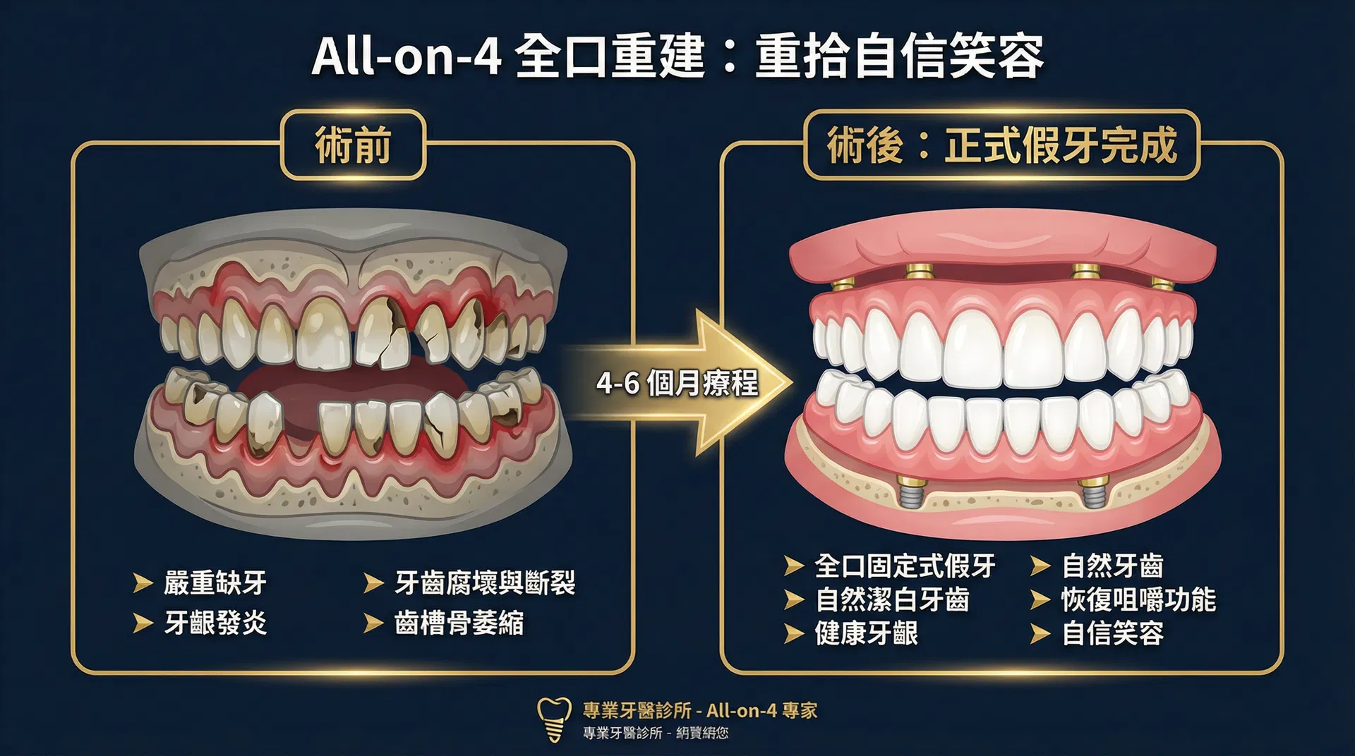 All-on-4 全口重建術前術後對比圖