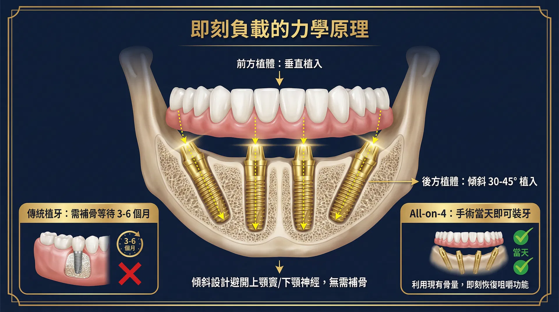 All-on-4 即刻負載的力學原理示意圖