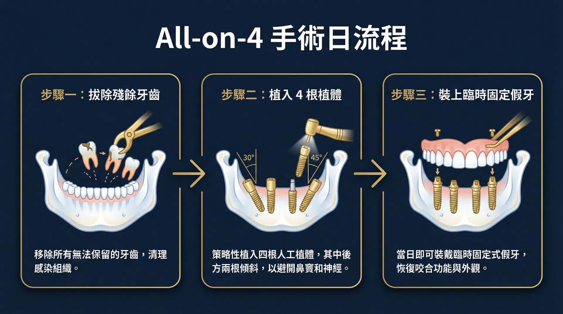 All-on-4 手術日流程：拔除殘餘牙齒、植入4根植體、裝上臨時固定假牙