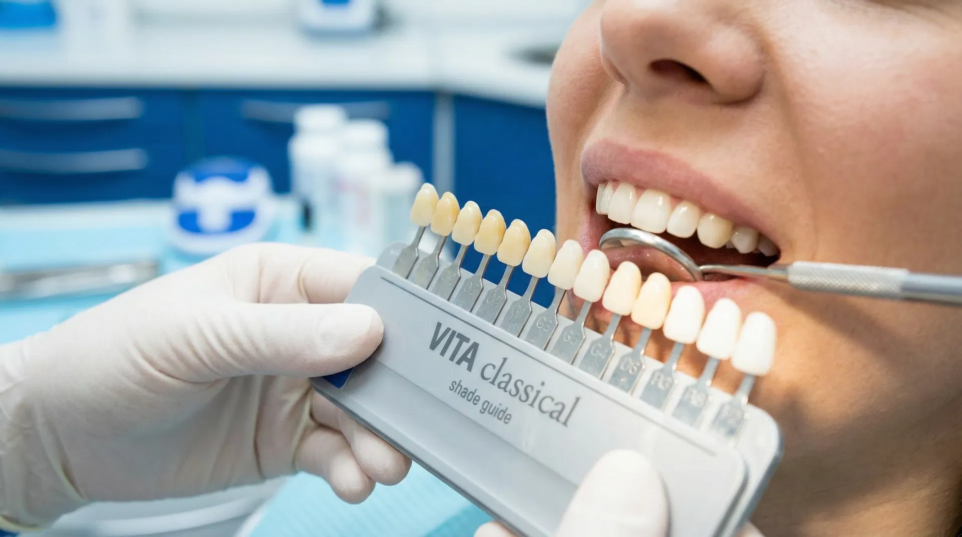 Escala de Clareamento Dental - Oris Odontologia Araucária Escala de cores para clareamento dental sendo comparada na Oris Odontologia Araucária PR - R. Pedro Druszcz 760