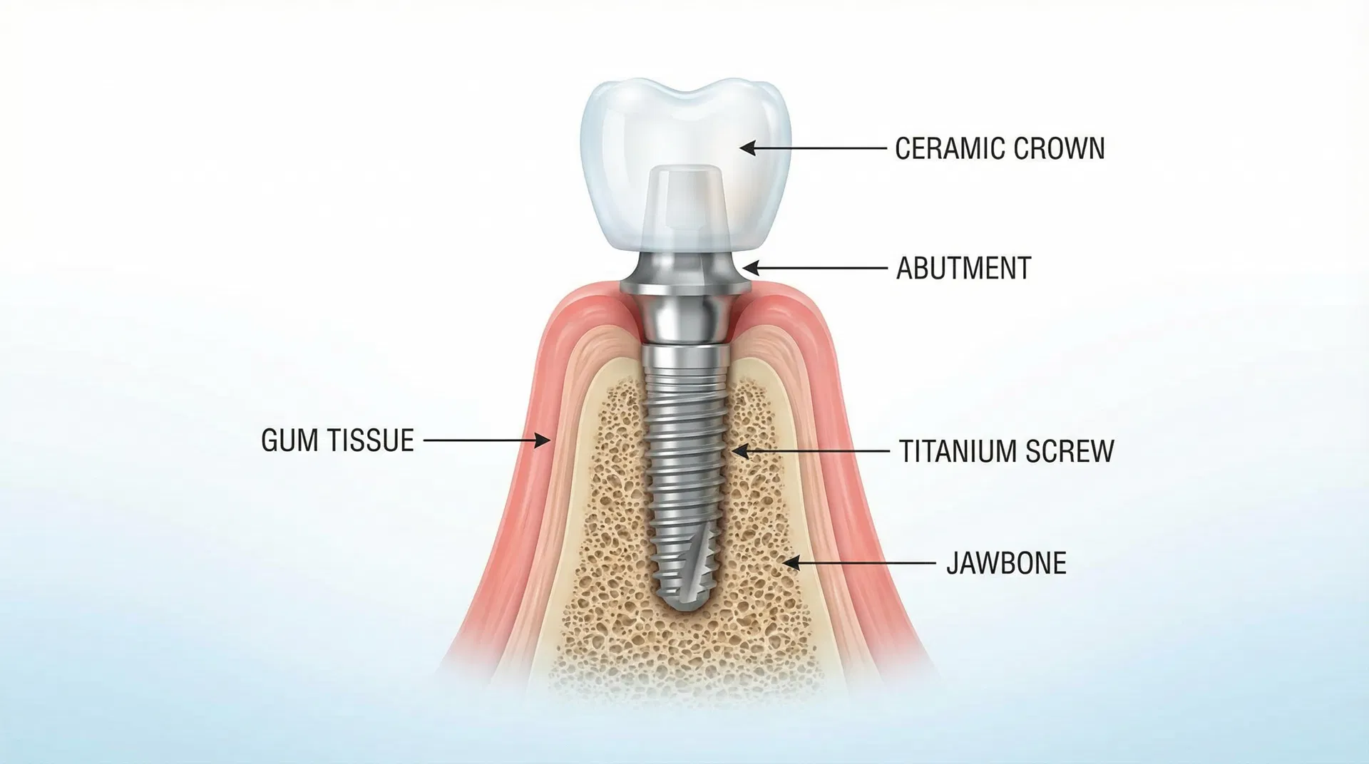 Ilustração anatômica de implante dentário mostrando parafuso de titânio, pilar e coroa cerâmica - Oris Odontologia Araucária PR