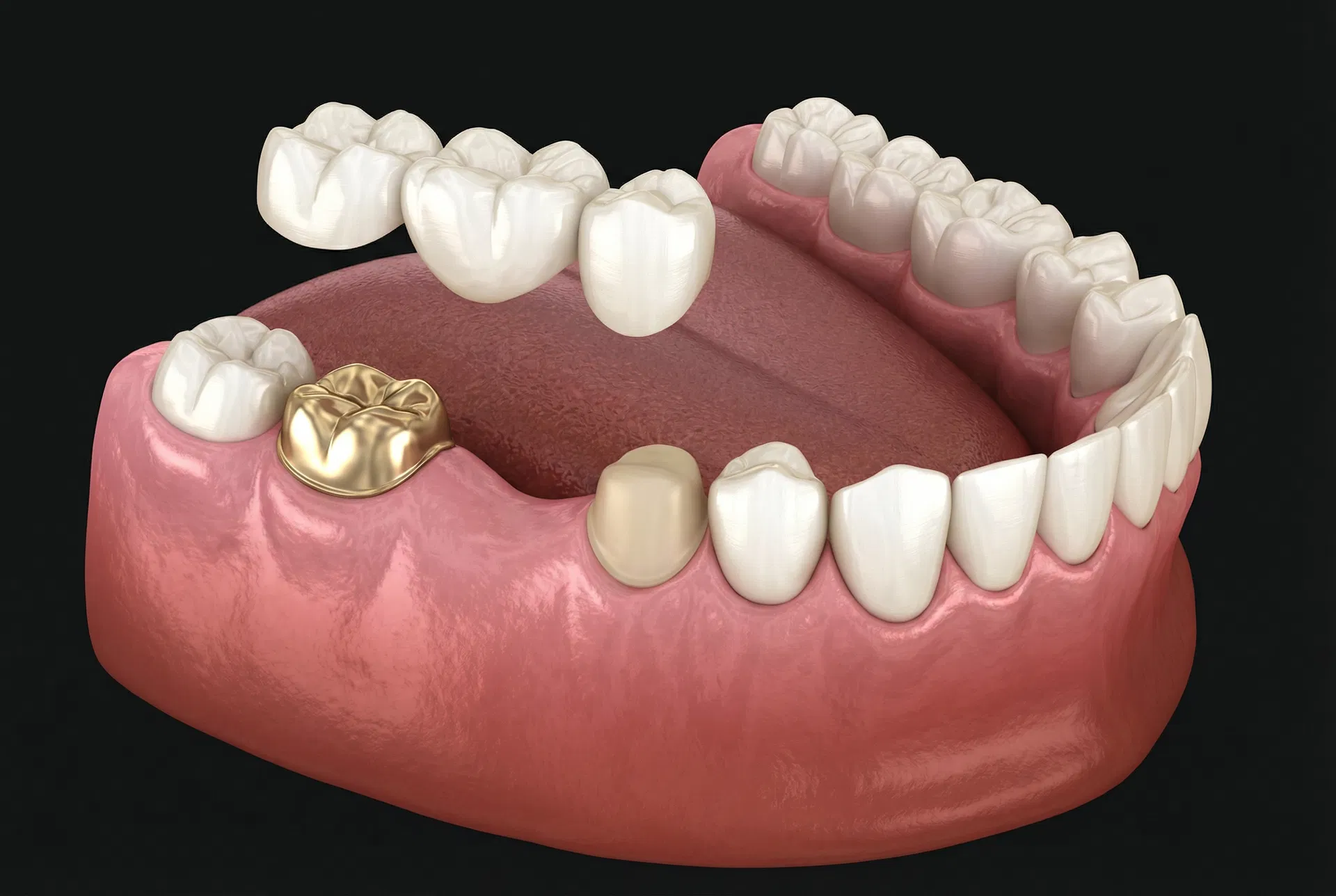 Crown and Bridge restoration model