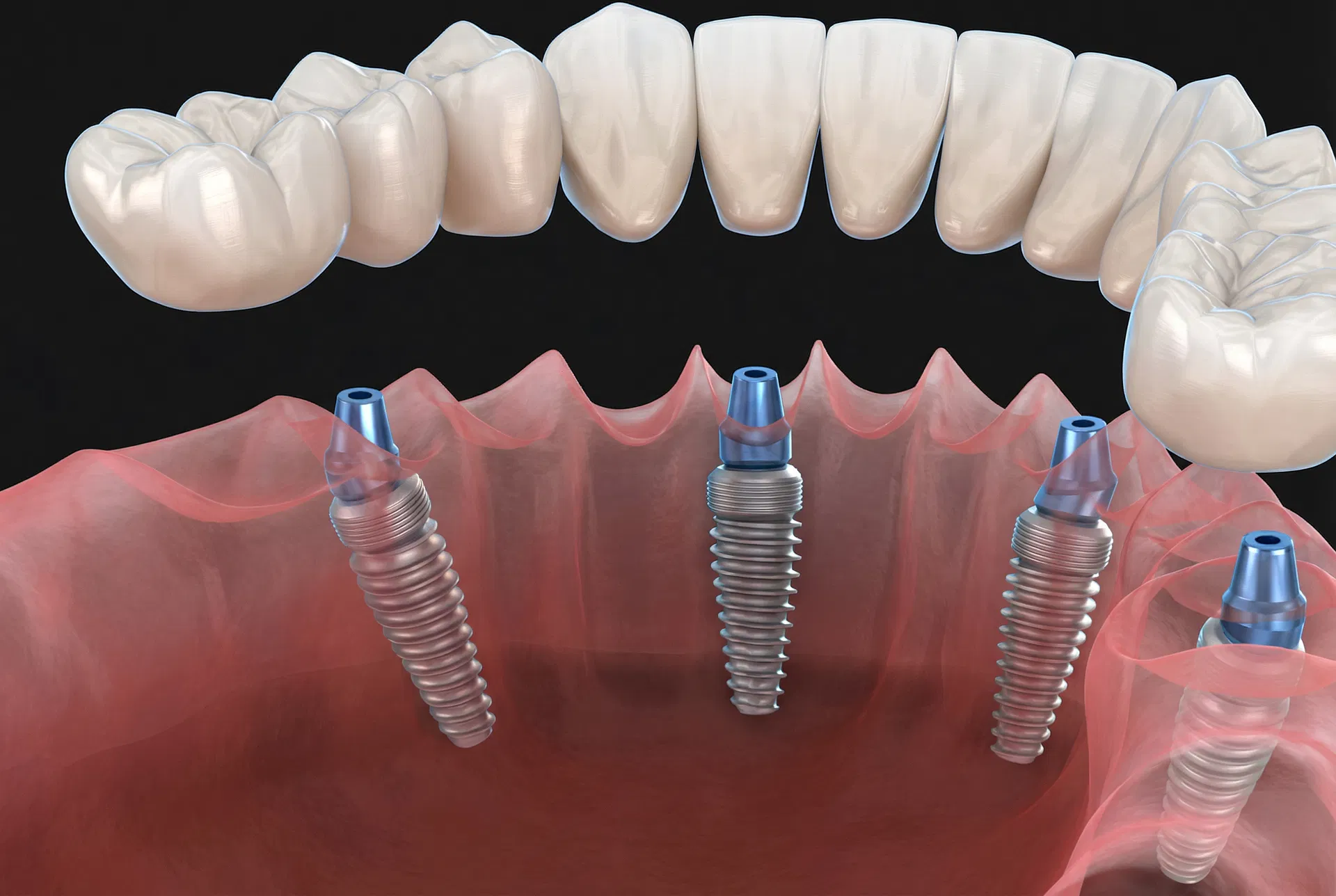 Dental implant solution model