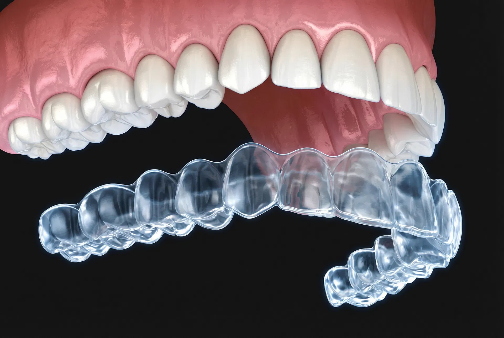 Clear dental aligner being fitted onto lower arch