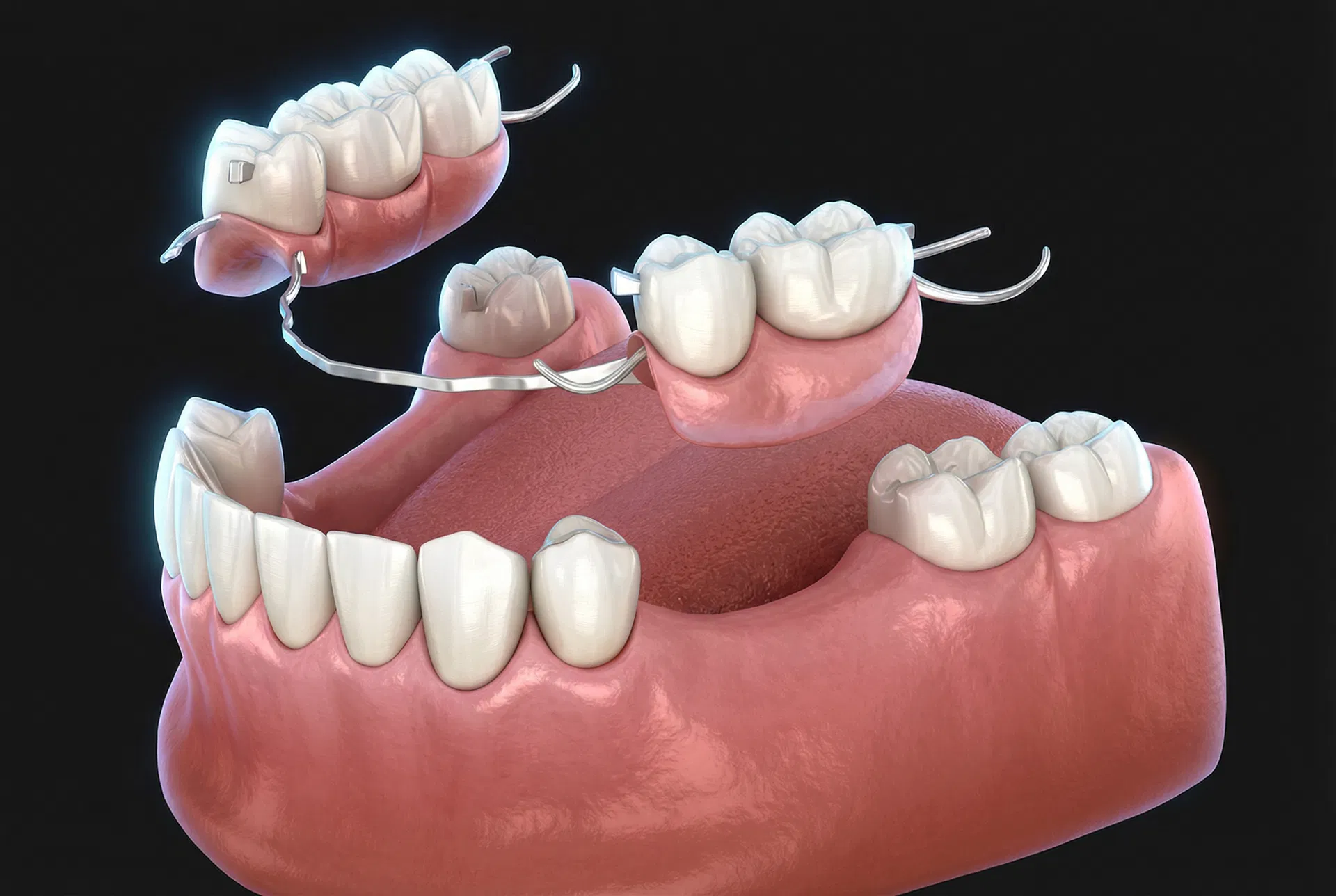 Partial denture restoration model