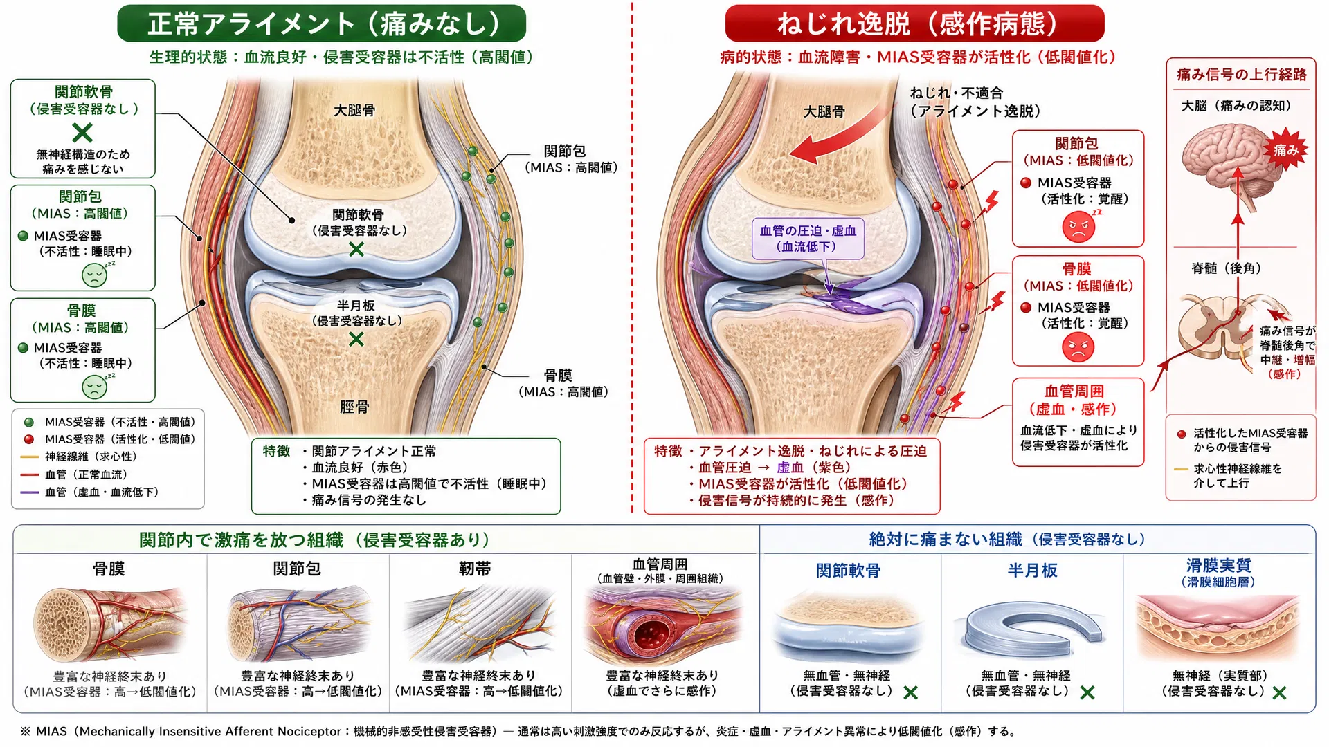 関節の侵害受容器：正常アライメント（MIAS高閾値・痛みなし）vs ねじれ逸脱（虚血による感作病態・MIAS低閾値化）