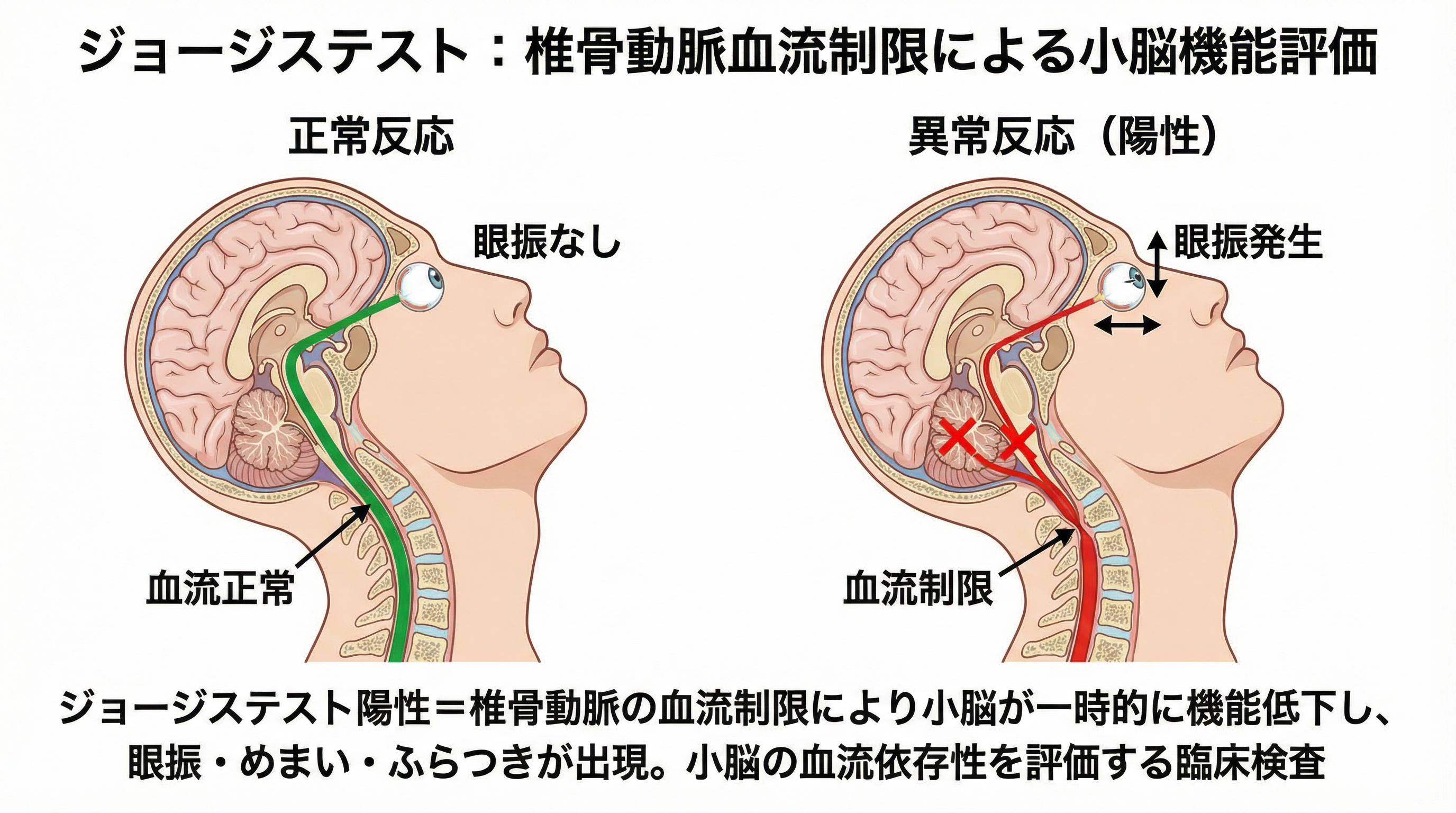 ジョージステスト：椎骨動脈血流制限による小脳機能評価