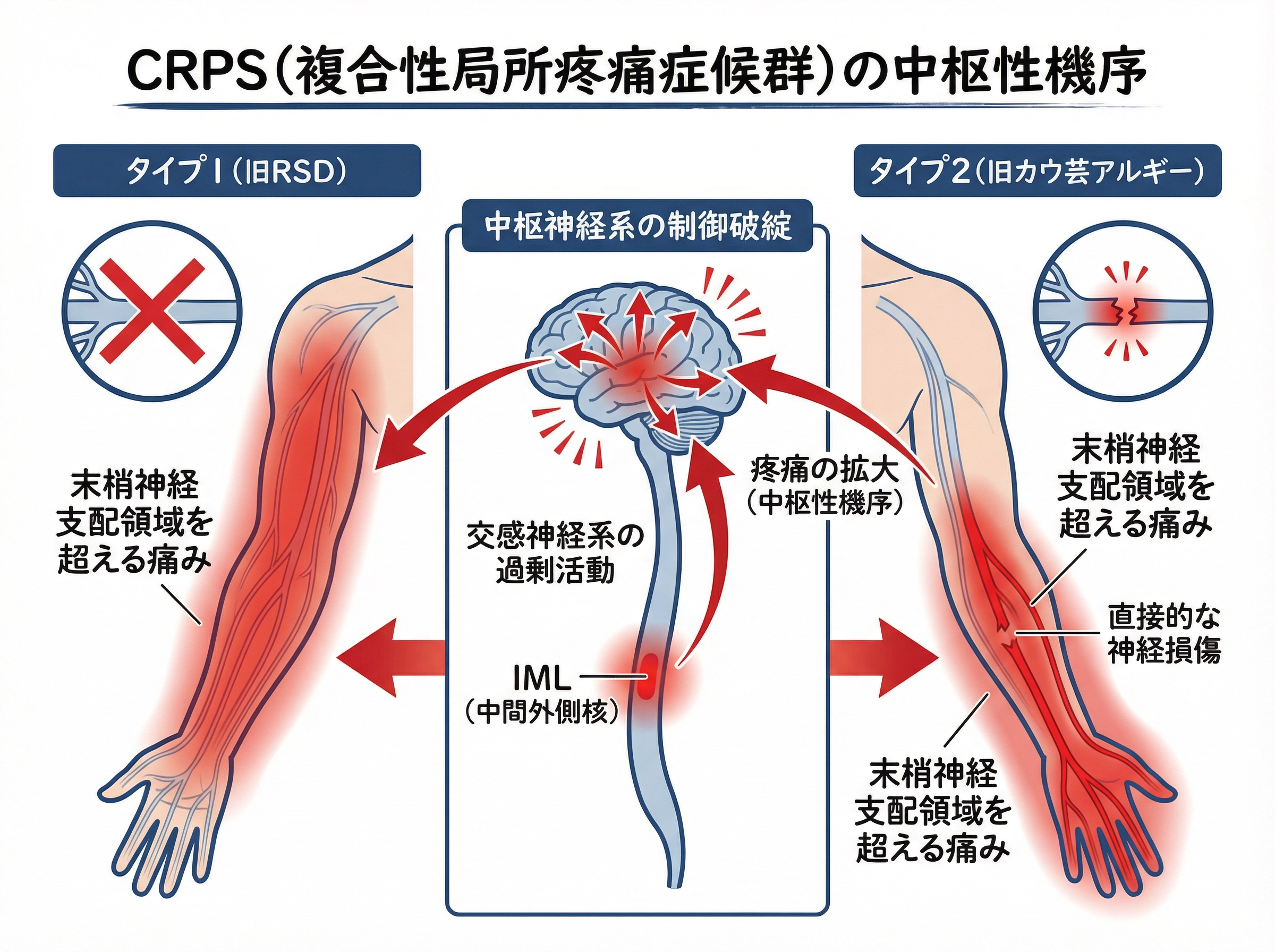 CRPSタイプ1（旧RSD）とタイプ2（旧カウザルギー）の比較。中枢神経系の制御破綻により末梢神経支配領域を超えた痛みが生じる。
