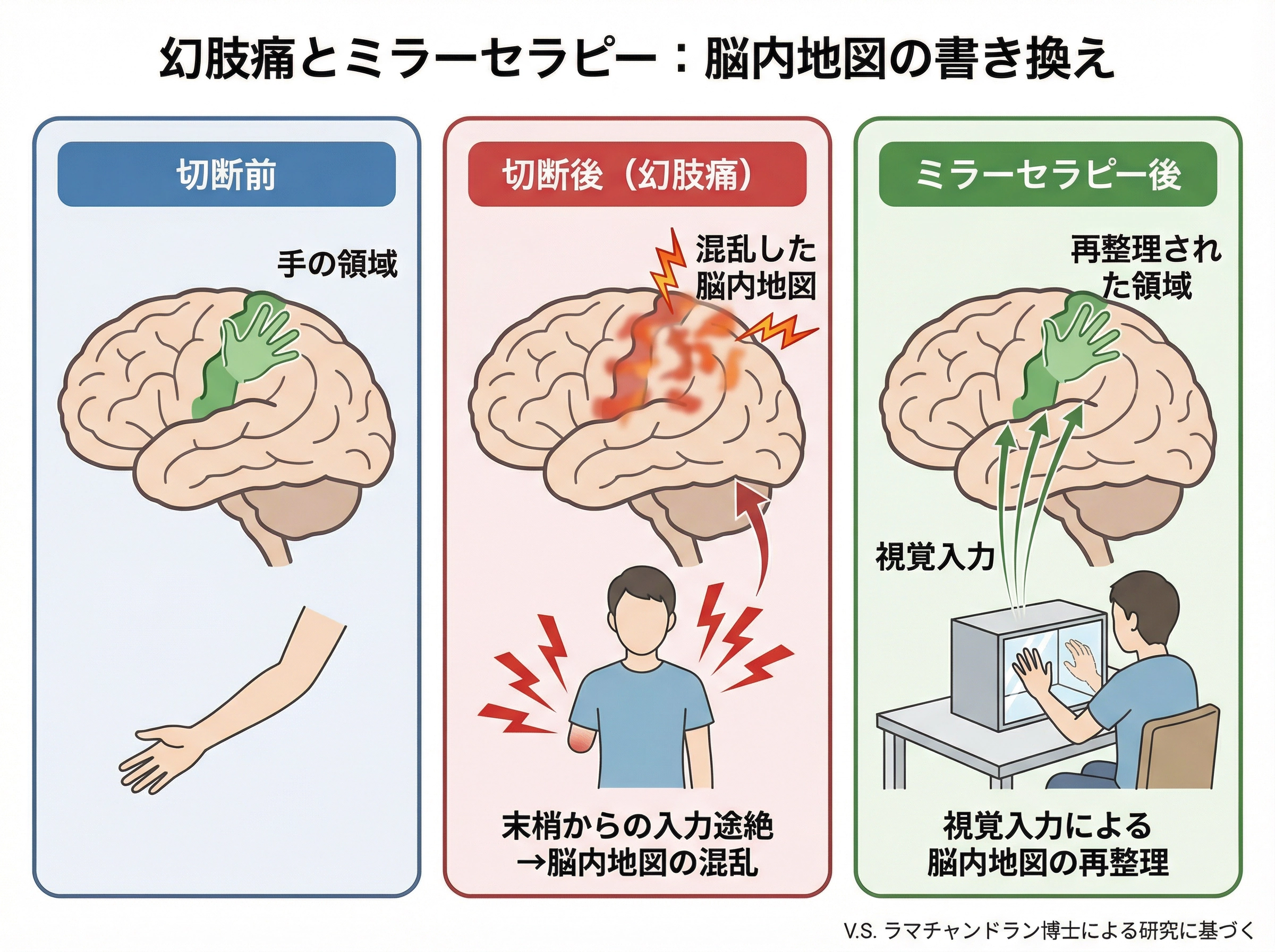 幻肢痛の原因は第一次感覚野の脳内地図の混乱。ミラーセラピーで視覚入力を送ることで脳内地図が再整理され、痛みが軽減する。