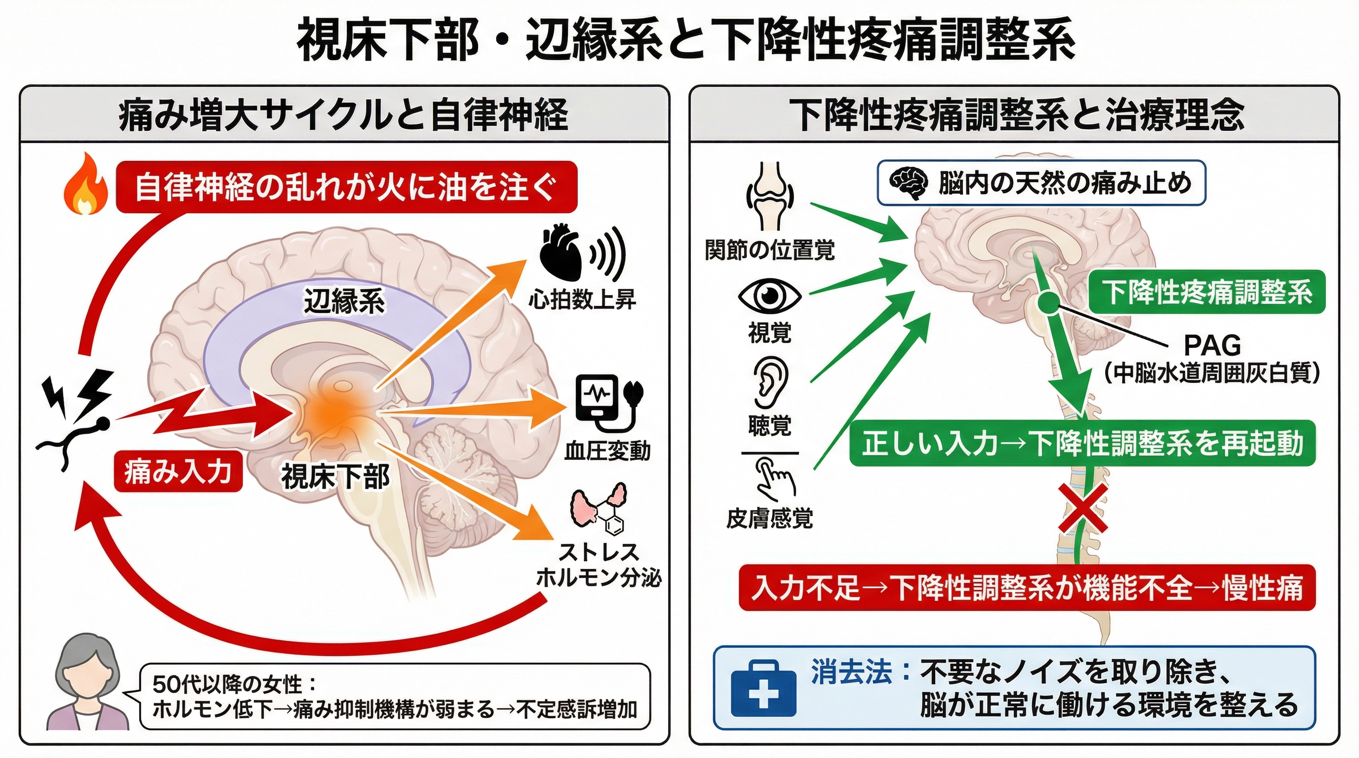 下降性疼痛調整系（PAG経由）は脳内の天然の痛み止め。入力不足→機能不全→慢性痛の悪循環を断つには、消去法（不要なノイズを取り除き正しい入力を整える）が有効。