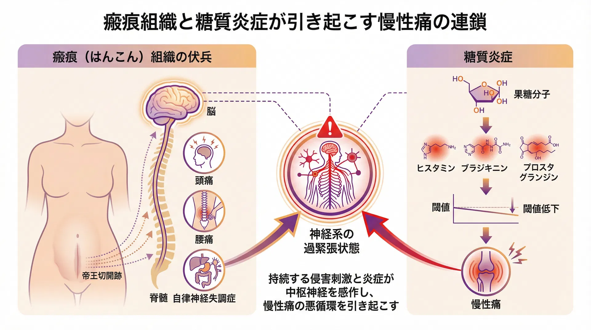 瘢痕組織と糖質炎症が引き起こす慢性痛の連鎖