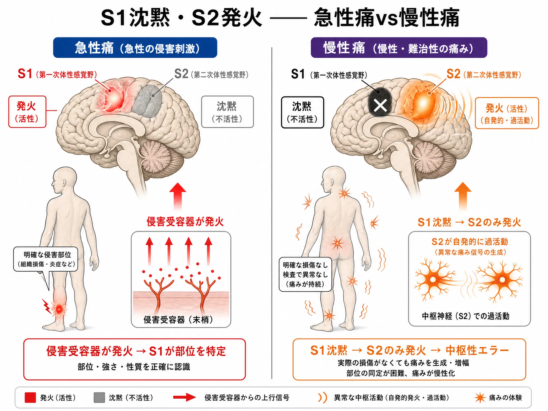 S1沈黙・S2発火 ―― 急性痛（S1活性）vs慢性痛（S1沈黙・S2のみ発火）の比較