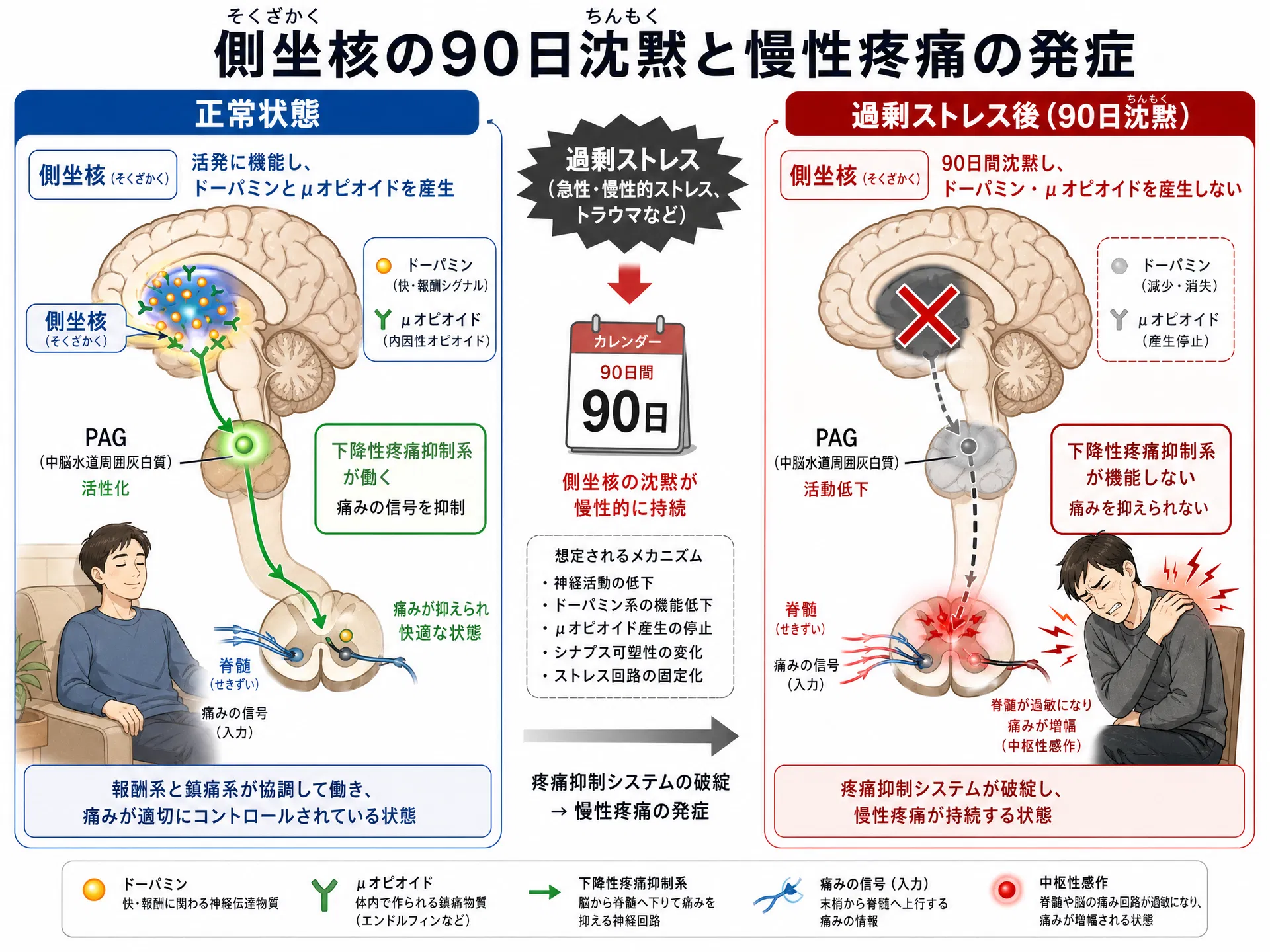 側坐核の90日沈黙と慢性疼痛の発症：正常状態と過剰ストレス後の比較