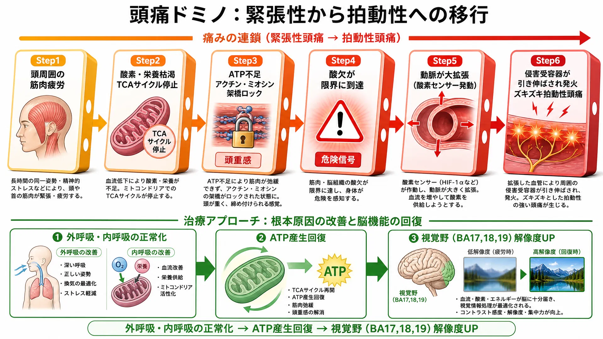 頭痛ドミノ：緊張性から拍動性への移行 ―― 筋肉疲労→TCAサイクル停止→ATP不足→筋肉ロック（頭重感）→酸欠限界→動脈大拡張→侵害受容器発火（ズキズキ）の6ステップと治療アプローチ