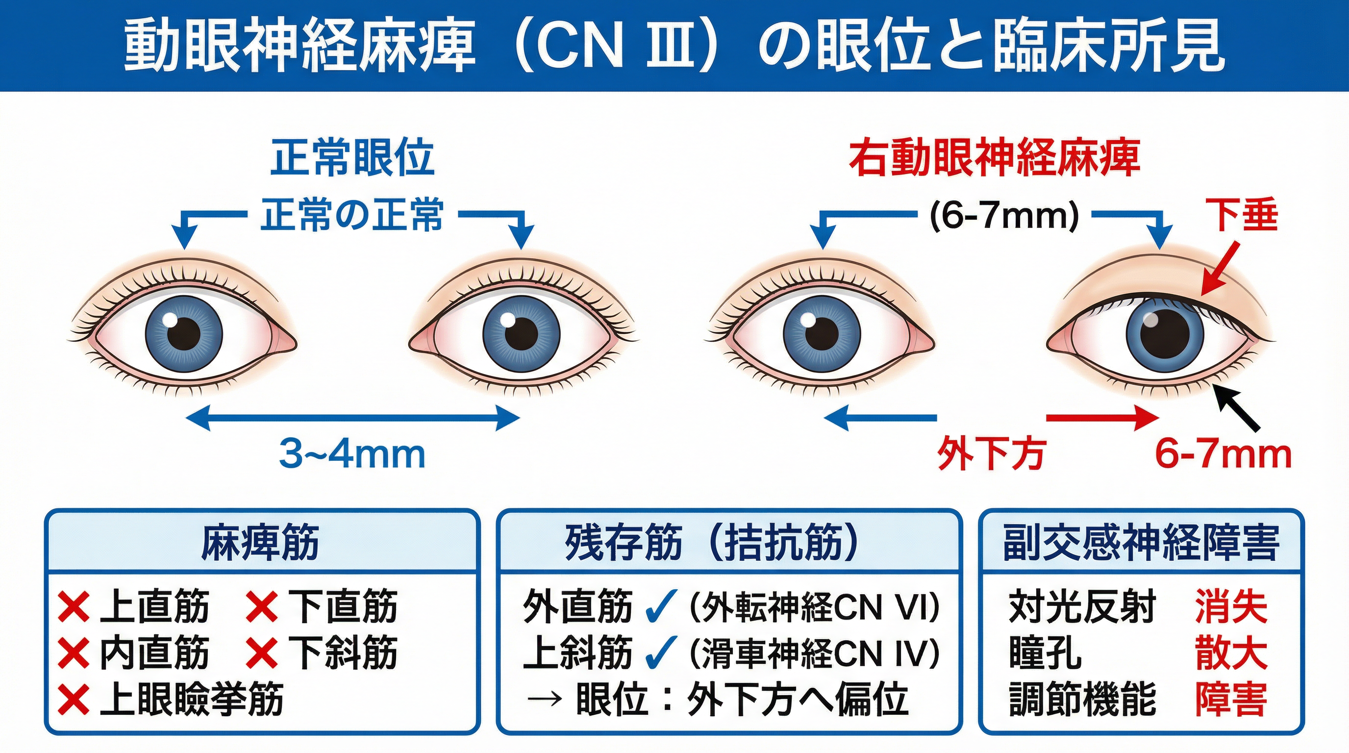 動眼神経麻痺（CN III）の眼位と臨床所見