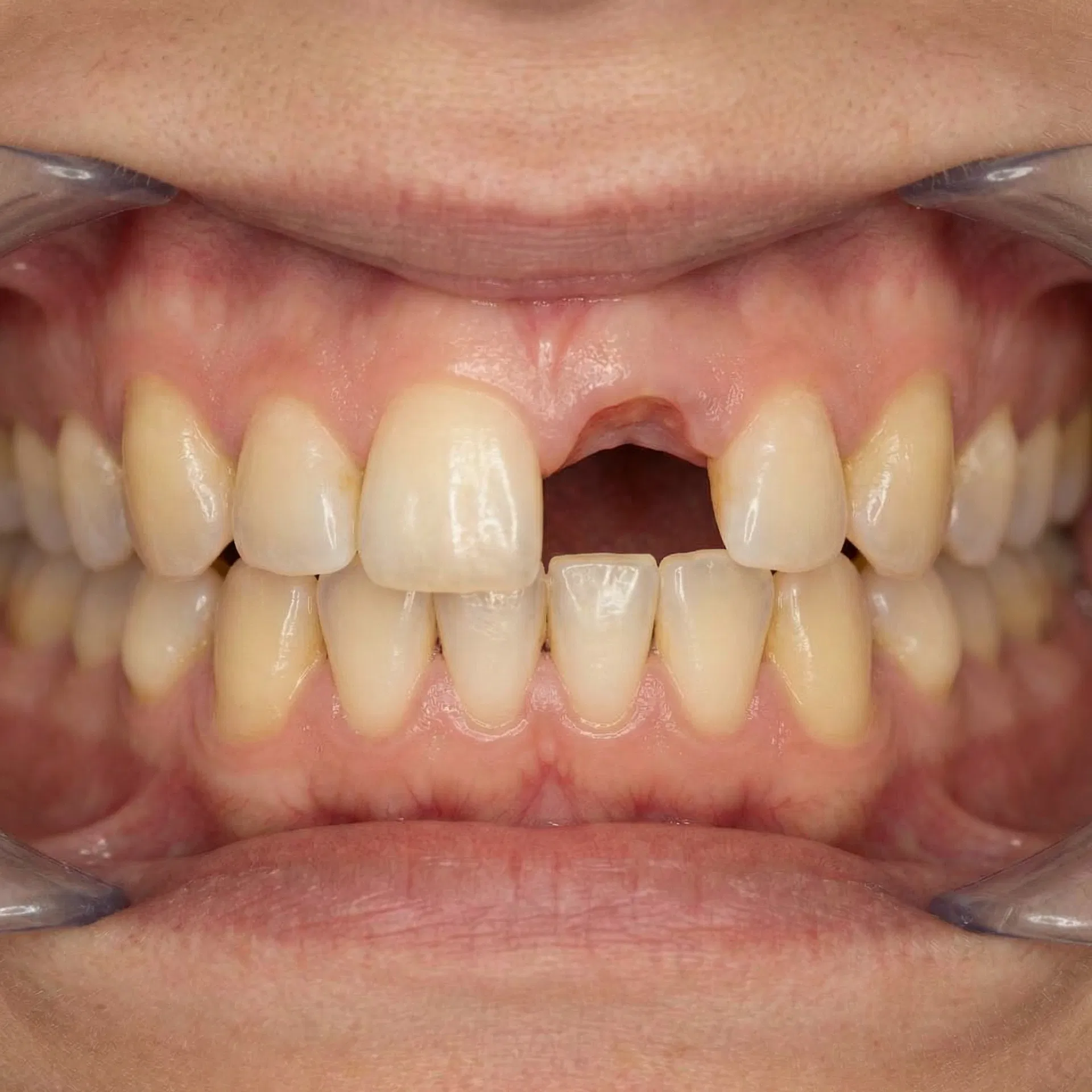 Before Single-Tooth Implant