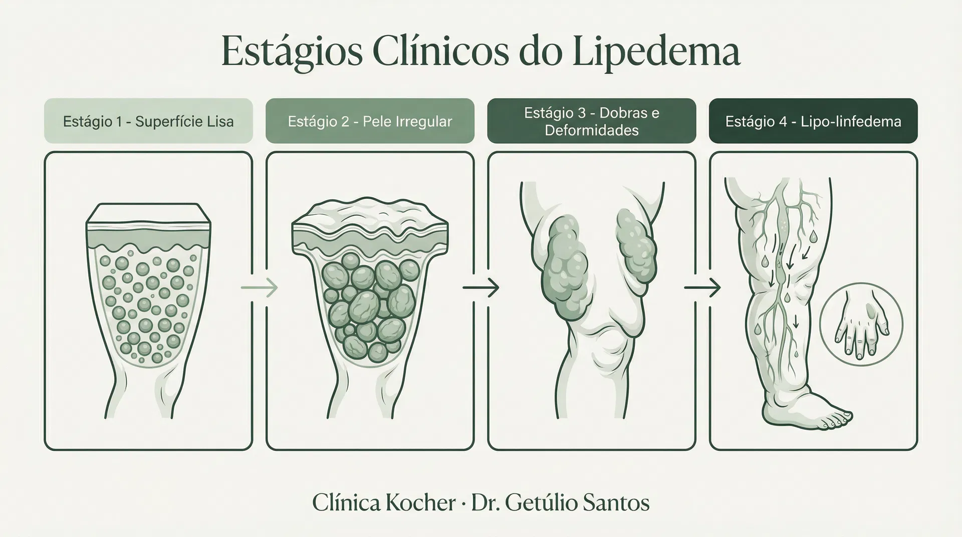 Infográfico dos 4 estágios clínicos do lipedema mostrando a progressão da doença