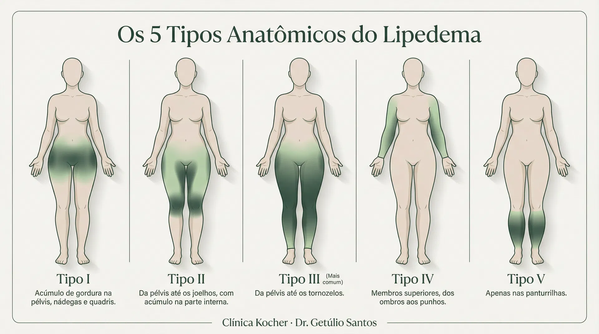 Infográfico dos 5 tipos anatômicos do lipedema mostrando silhuetas femininas com as áreas afetadas destacadas