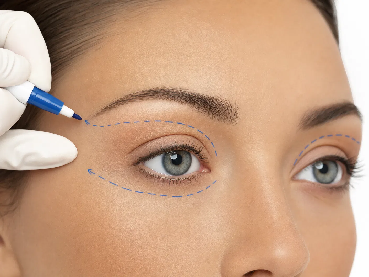 Eyelid Surgery