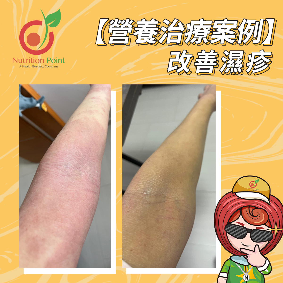 手部濕疹 - 前vs後