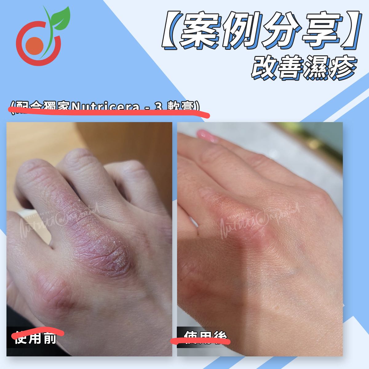 手部濕疹 - Before and After