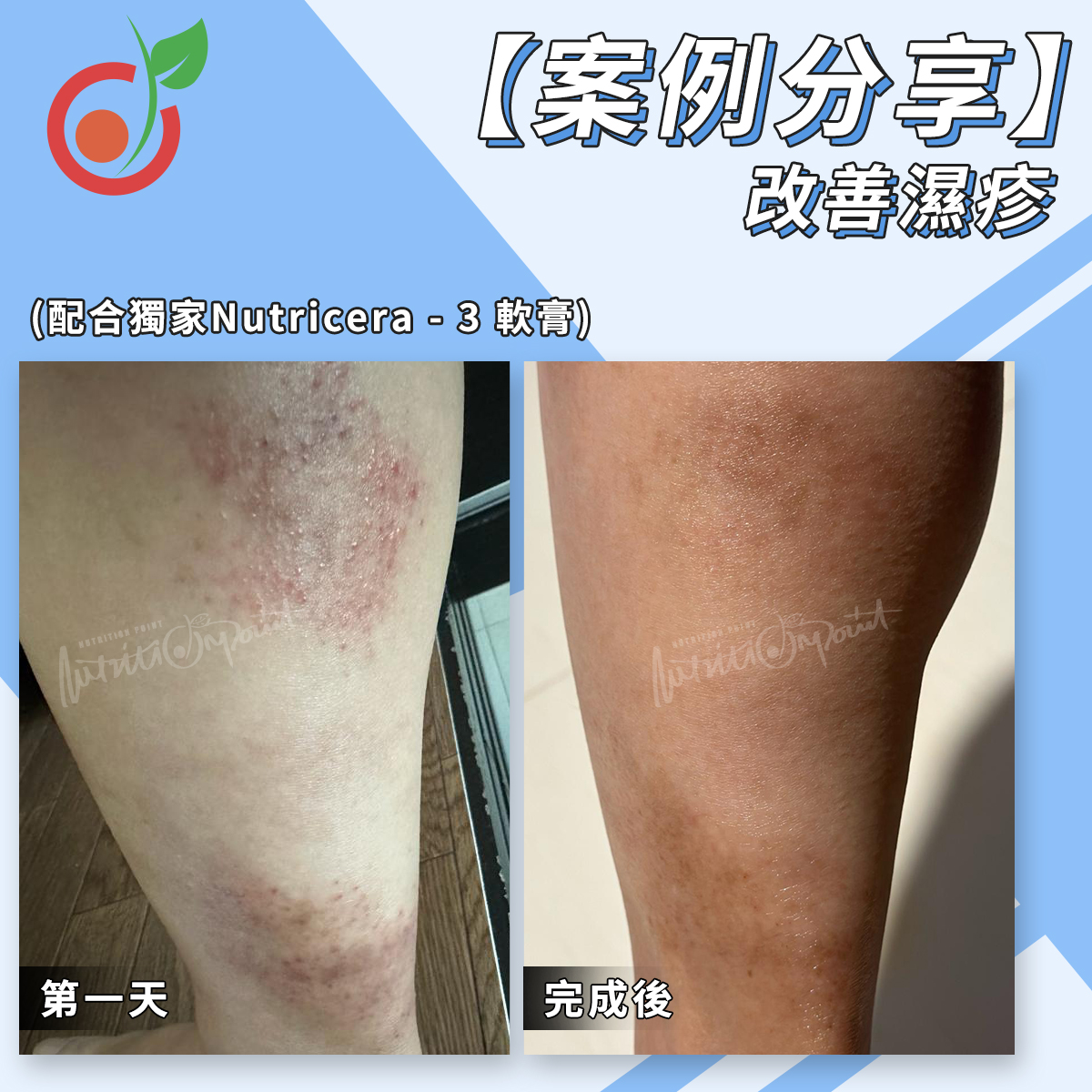 腳部濕疹 - Before and After